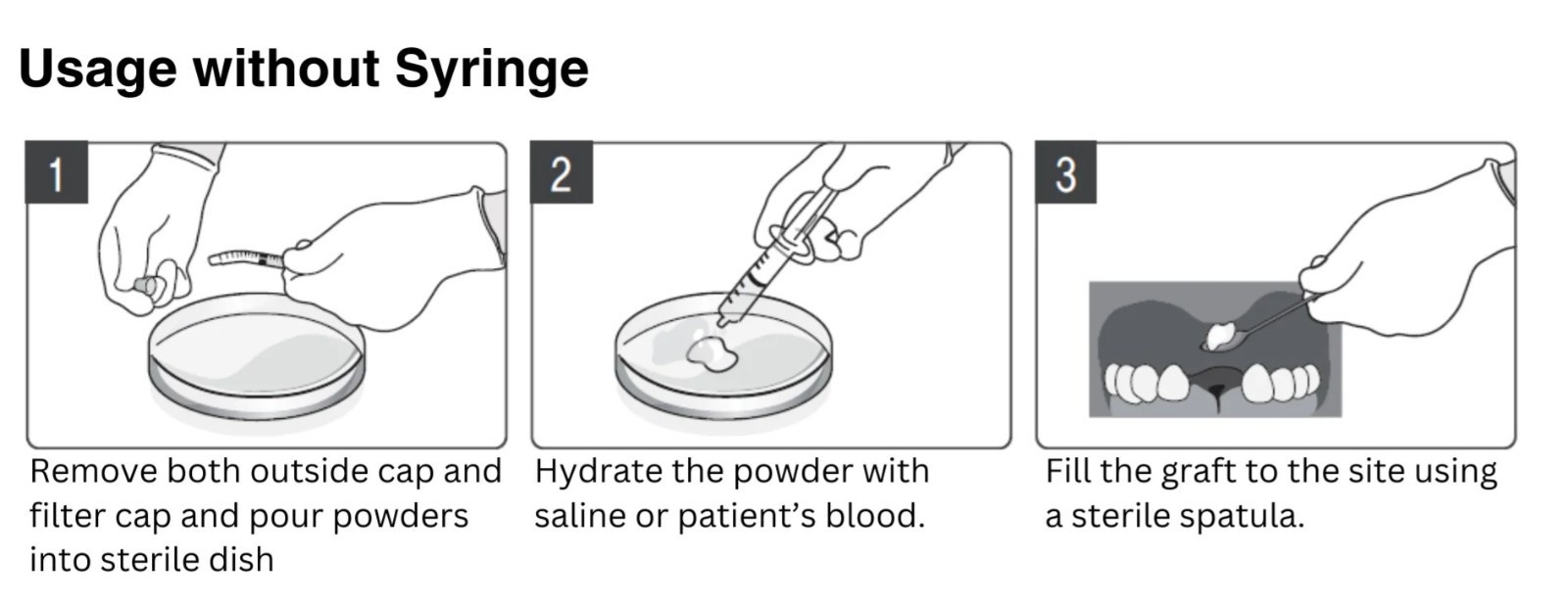 Allograft Cortical/Cancellous 2 Powder in a Syringe 0.5 cc, Total 1.0cc FDBA