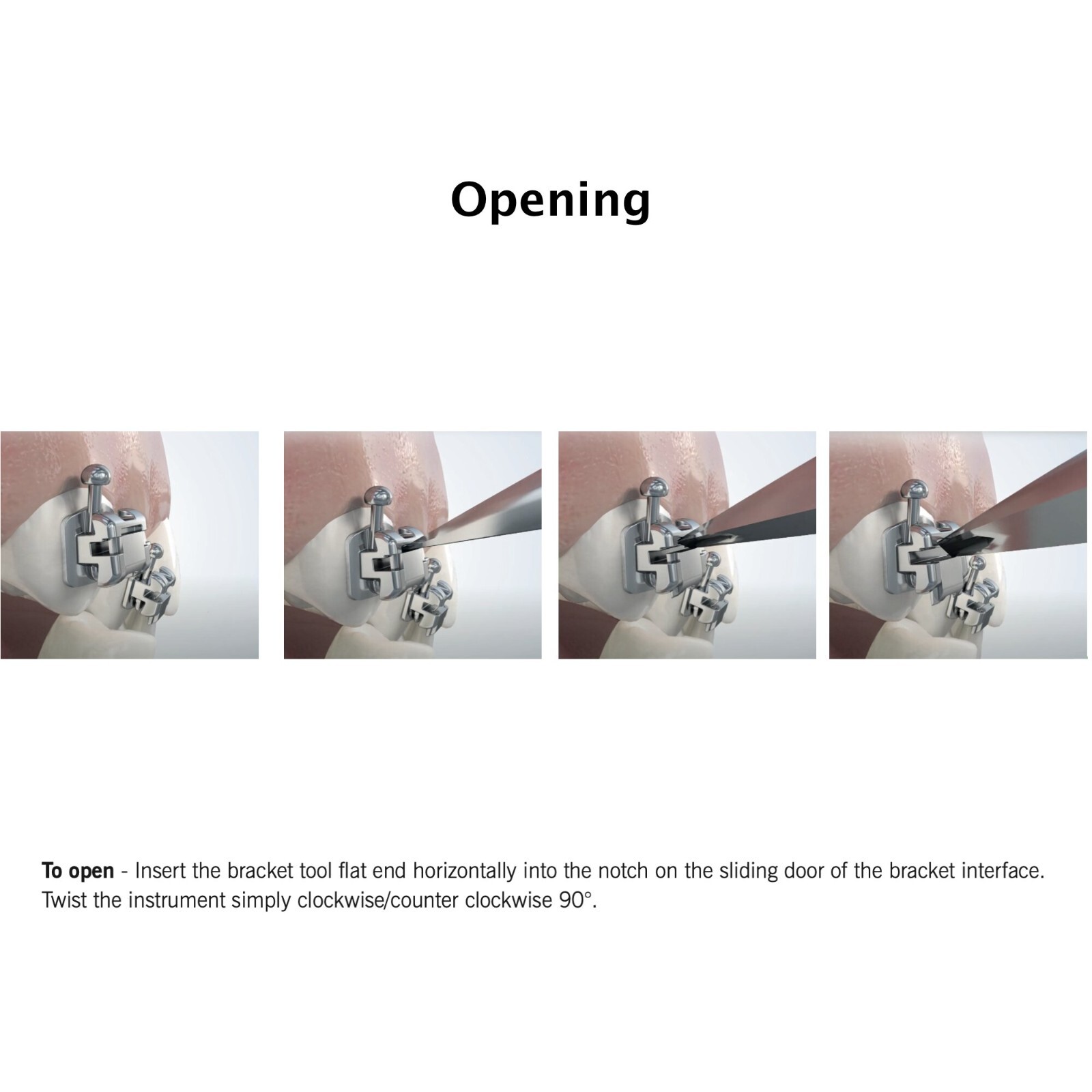 Dental Self Ligating Brackets Orthodontic Ceramic Metal Roth MBT Damon Empower