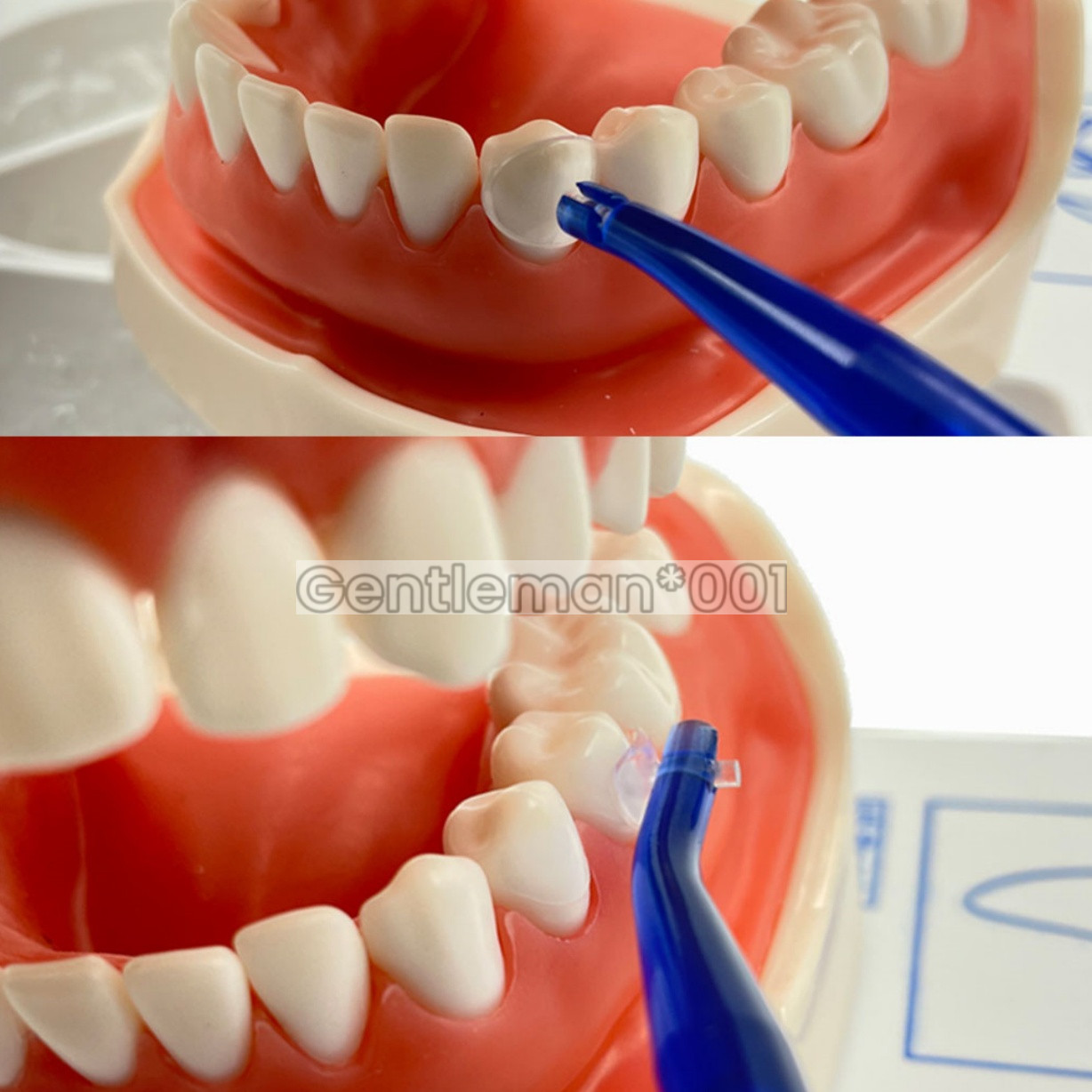 Dental Transparent Cervical Matrices Composite Gingival Matrix Kerr Premolar