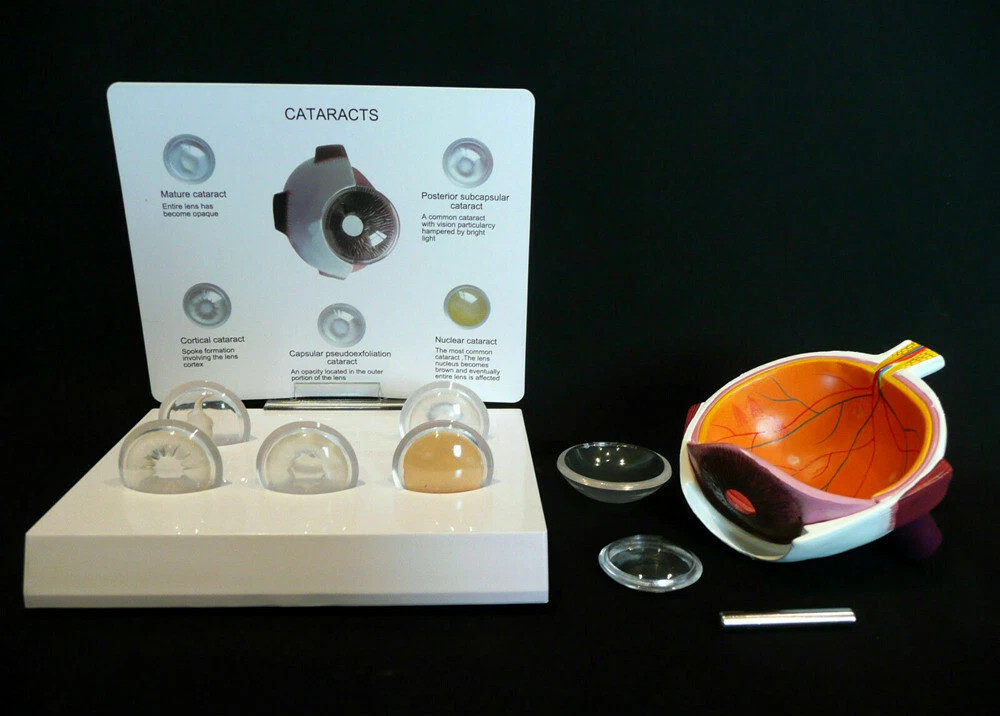 Anatomical Model of Human Cataract and Eye Disease-Medical Pathology Anatomy