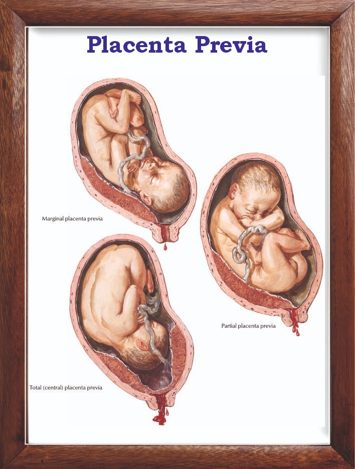 Placenta Previa Chart 12×18 inches