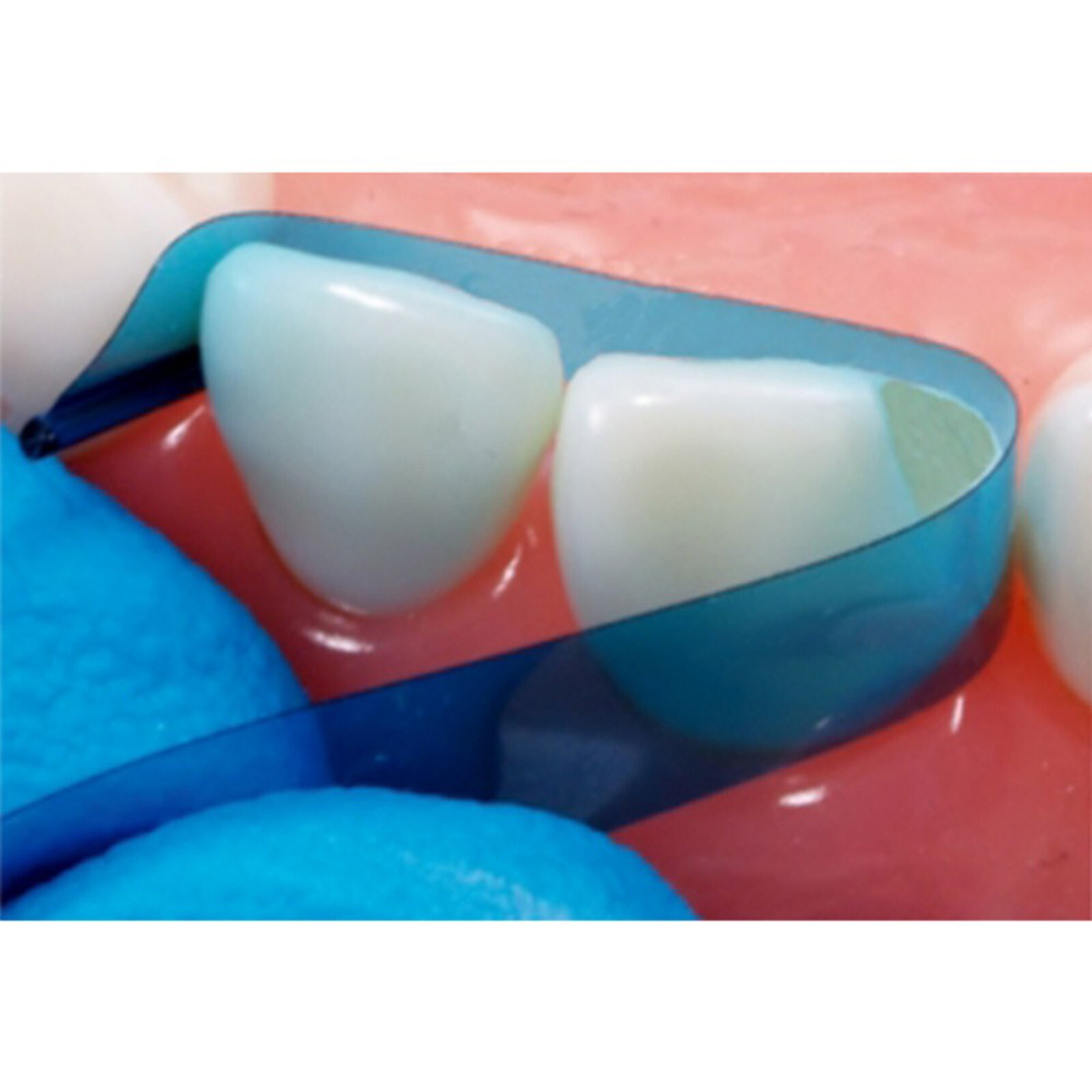 Dental Contoured Anterior Matrix Bands Polyester Anterior Strips Matrices System