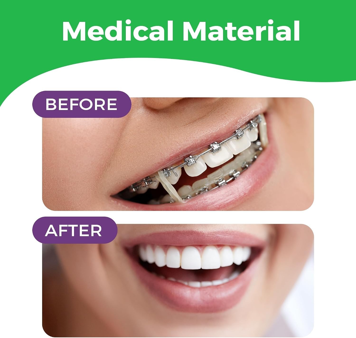 Durable Neon Rubber Bands for Braces 300 Pack – Perfect for Orthodontics & Hair