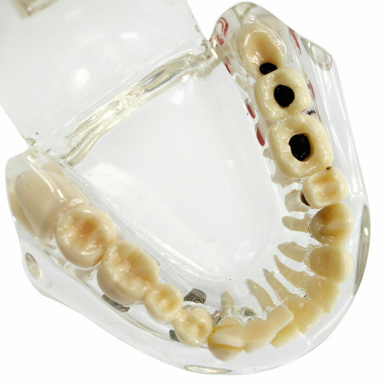 Dental Fake Teeth Study Model Implant Disease Education Denture Teach Analy