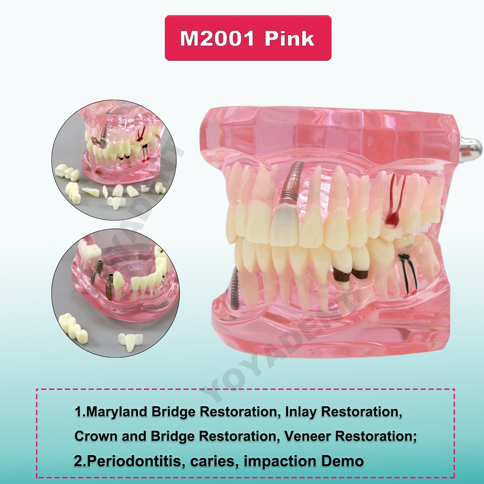 US Dental Teeth Model Implant Periodontal Disease Suture Drilling Training Demo