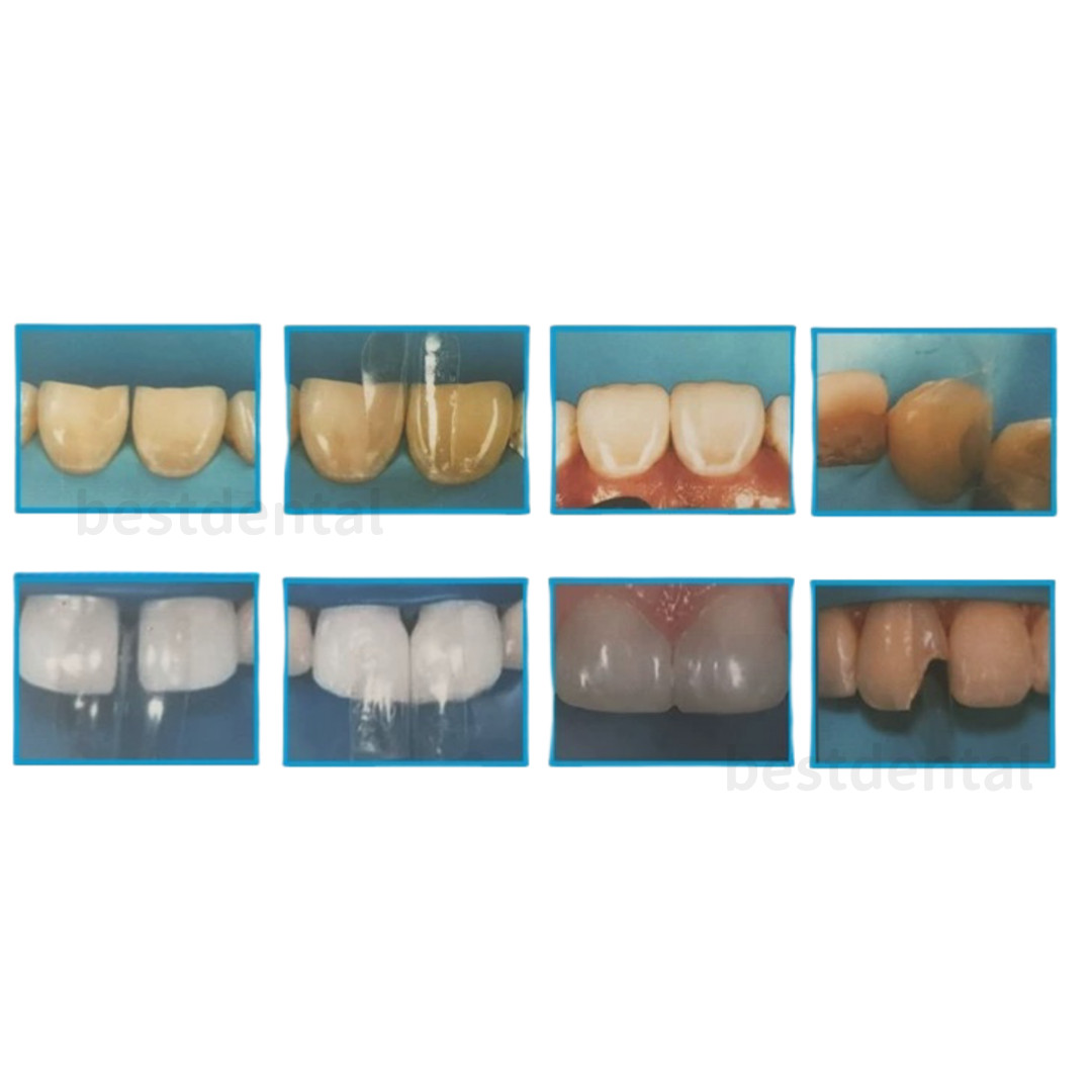 1.901 Mixed Sizes Dental Clear Matrix Anterior Matrices Bow BT Fits Bioclear