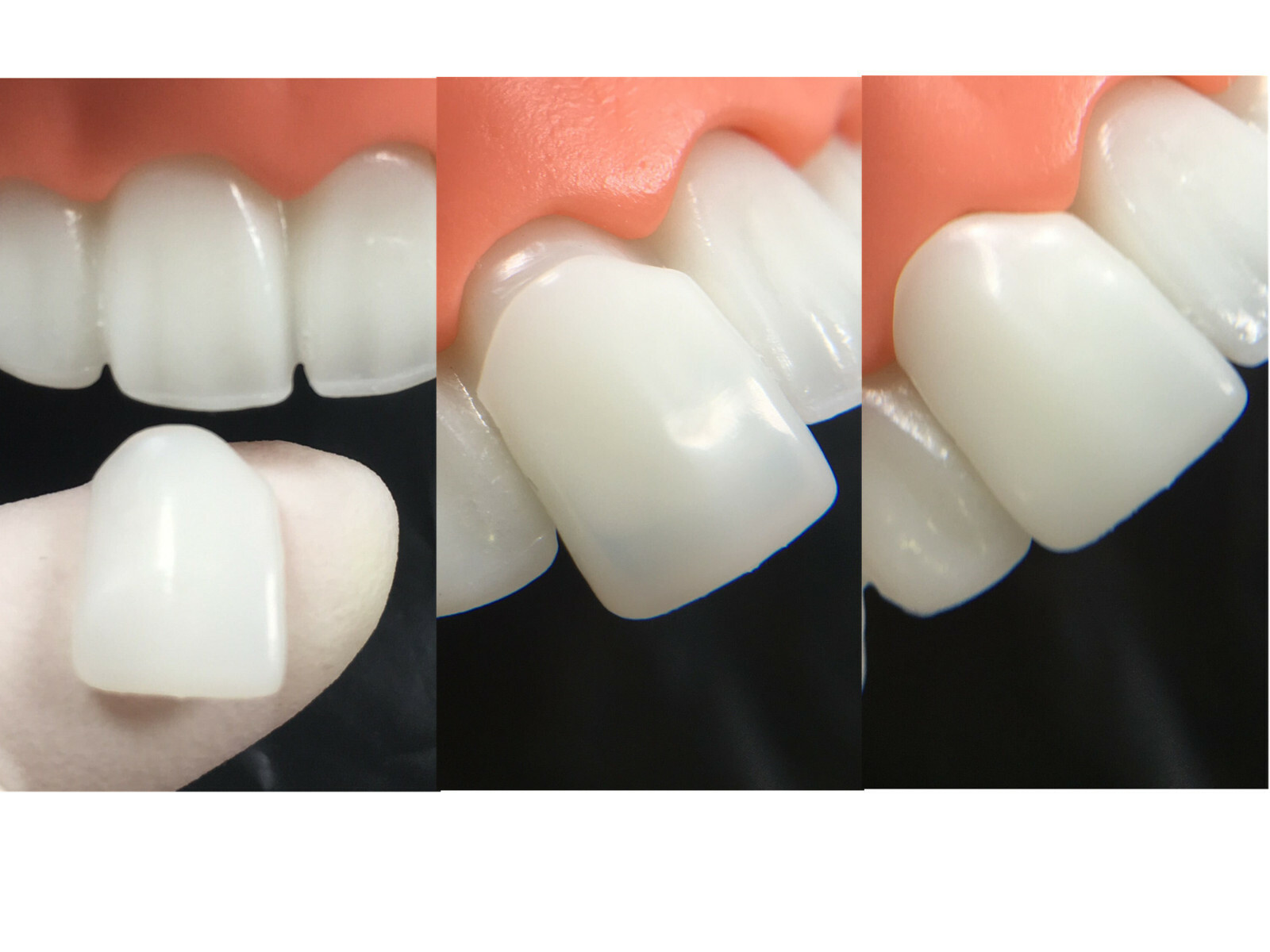 Dental Composite Veneer Template Front Teeth Practise Model Dentist Teaching