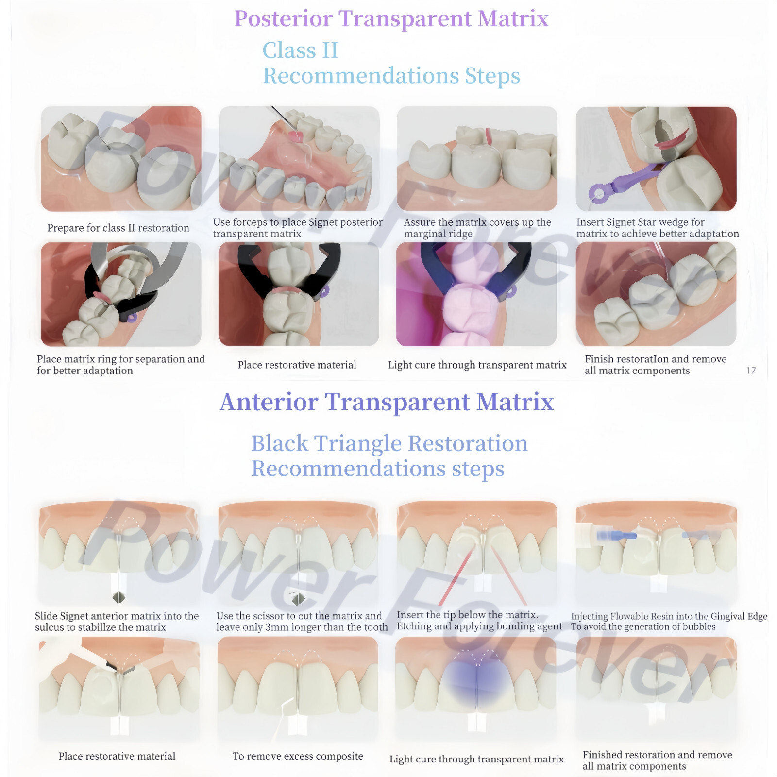 20pcs Dental Posterior Clear Matrix Molar Restorative Matrices BT Fit BioClear