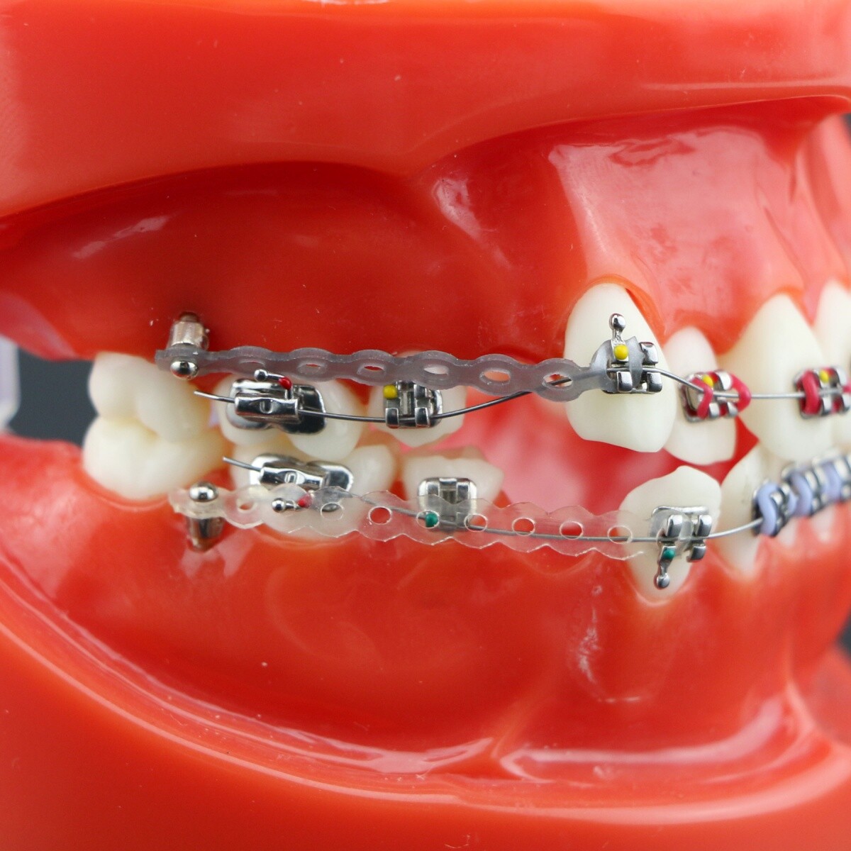 Dental Typodont Teeth Model Orthodontic Treatment Metal Ceramic BracketsRetainer