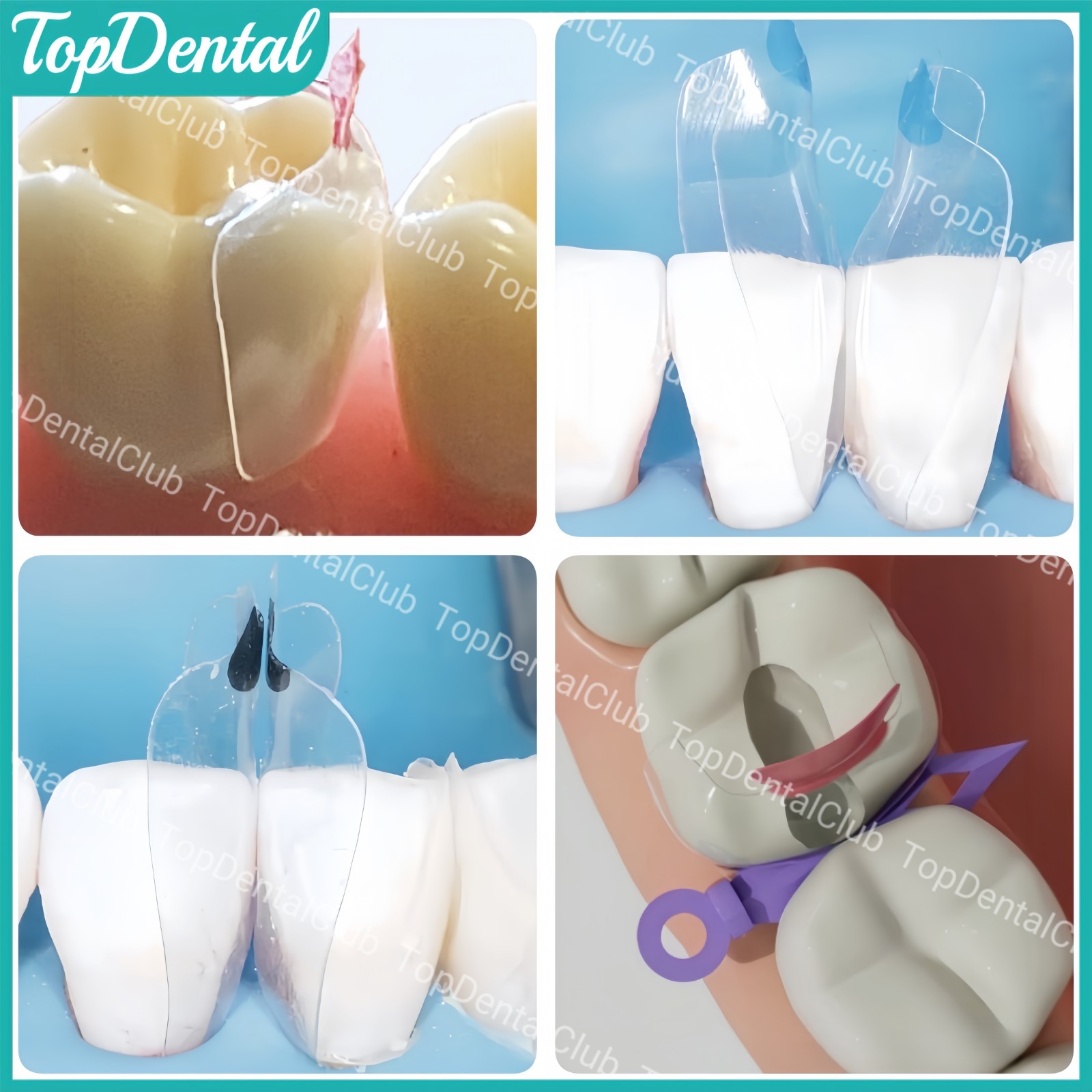 Clear Matrix Dental Anterior Posterior Transparent BT Matrices Fit BioClear