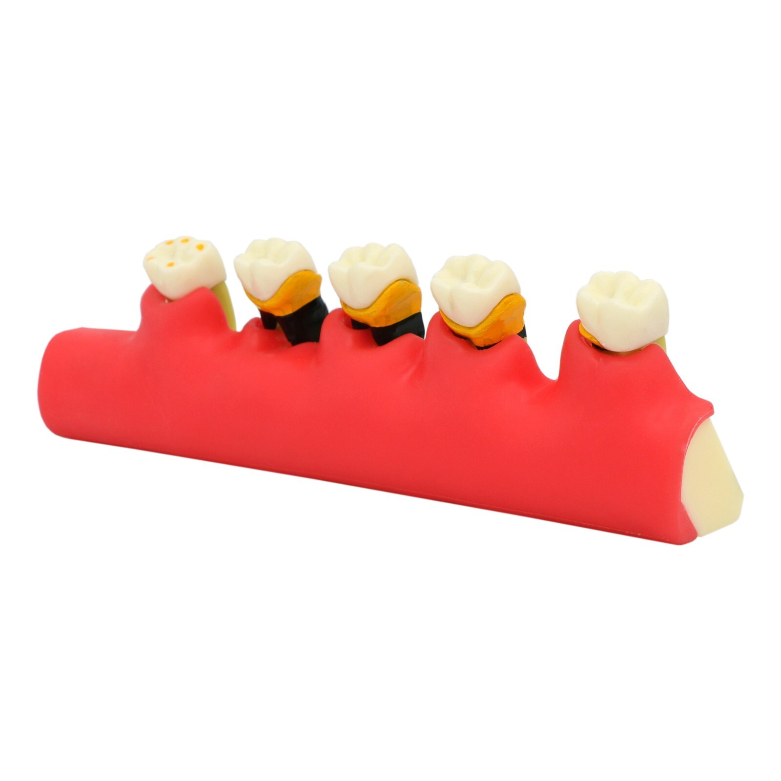 Dental Periodontics Disease 5-Stage Teeth Model Perio Disease Assort Demo Model