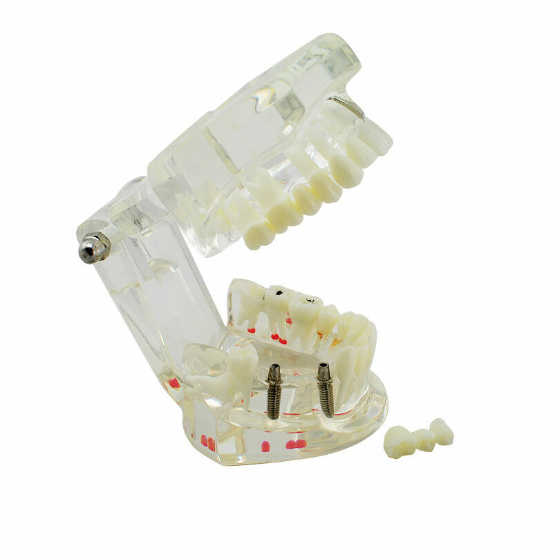 Dental Implant and Restoration Model Transparent Pathological Teeth Study Model