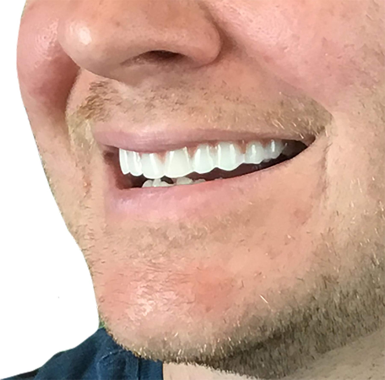 Instant Smile Comfort Fit Flex – Bright Shade – Upper 1 Count (Pack of 1)