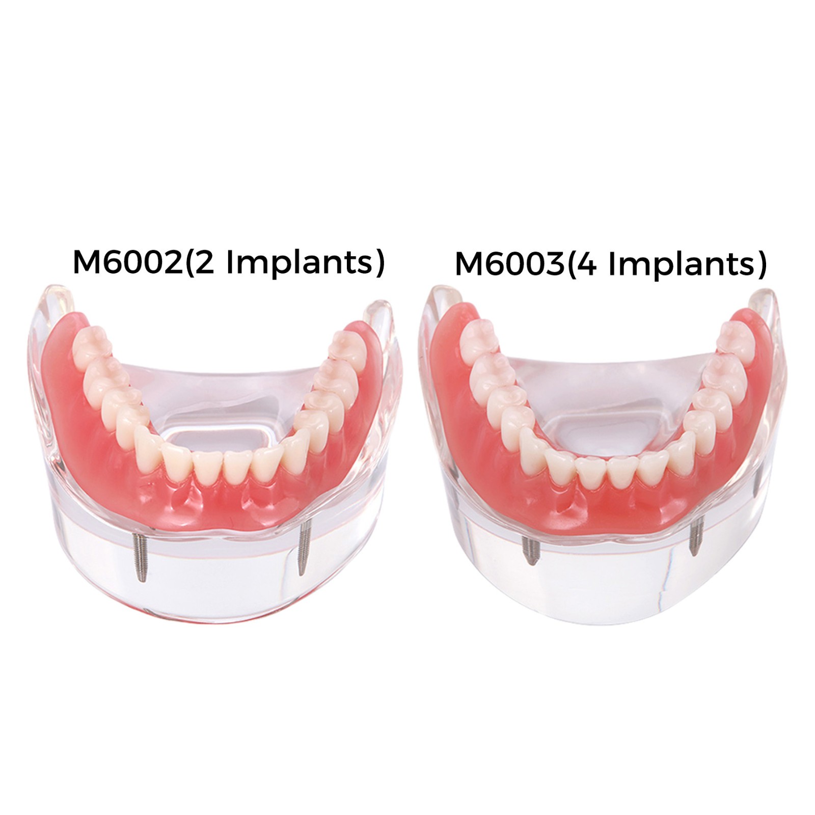 Dental Teeth Model 2 4 Implant Overdenture Typodont Restoration Demo Upper Lower