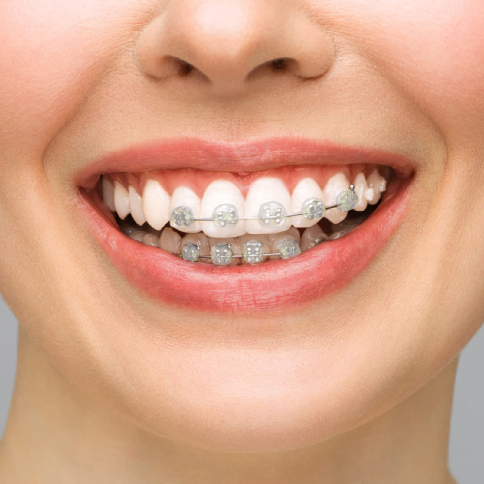 BVN Braces Wax Dental Wax: 10 Boxes Orthodontic 10 Boxes-multi-colored