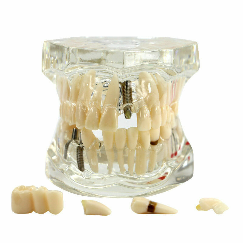 Dental Fake Teeth Study Model Implant Disease Education Denture Teach Analy
