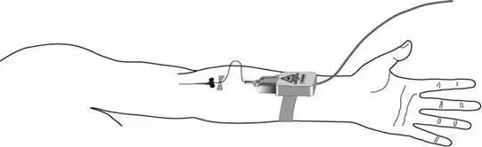 KIVL-01 Disposable Sterile Fiber Optic Light Guides for Intravenous Laser Blood
