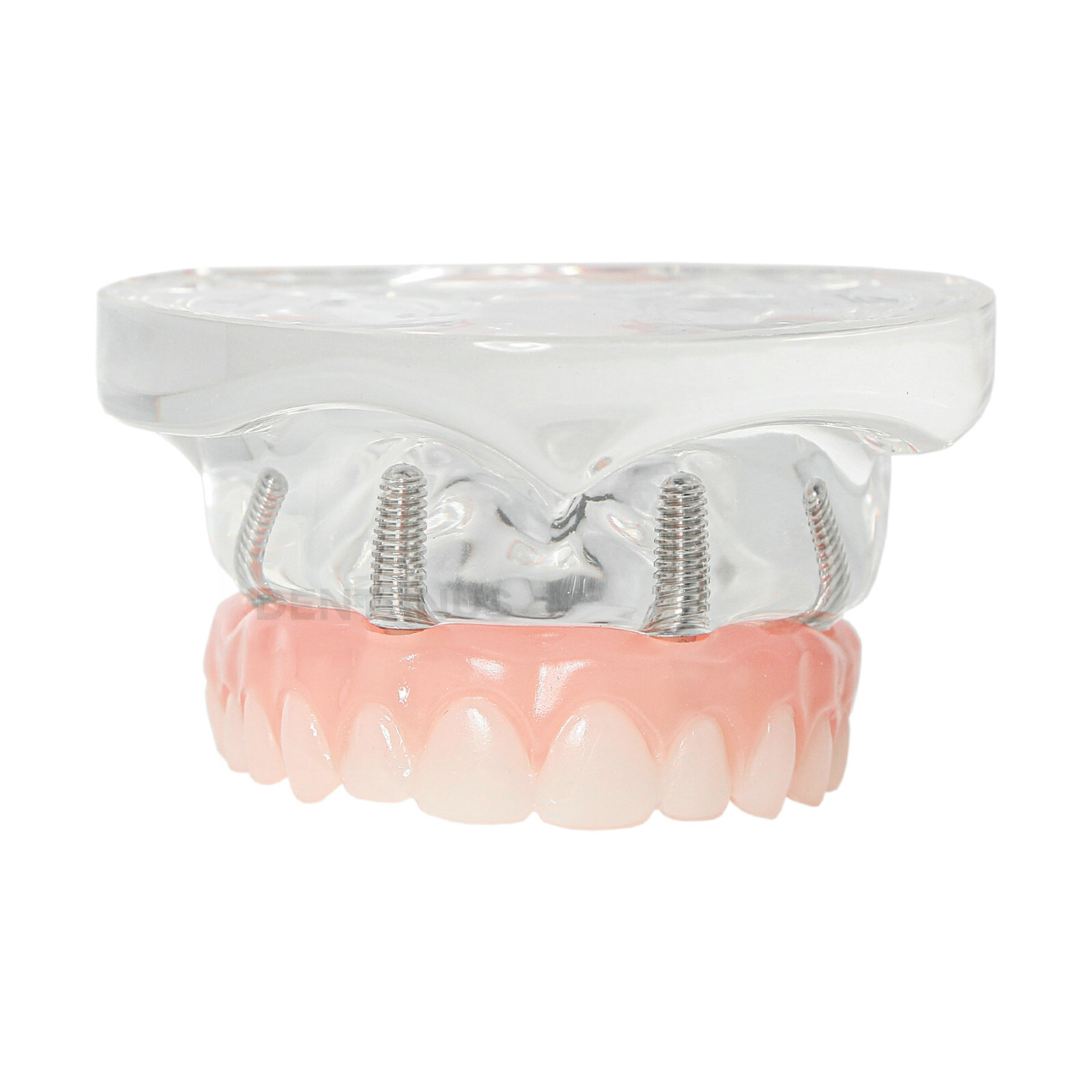 Dental 4 Implants Demo Implant Teeth Model Restoration Overdenture Upper/Lower