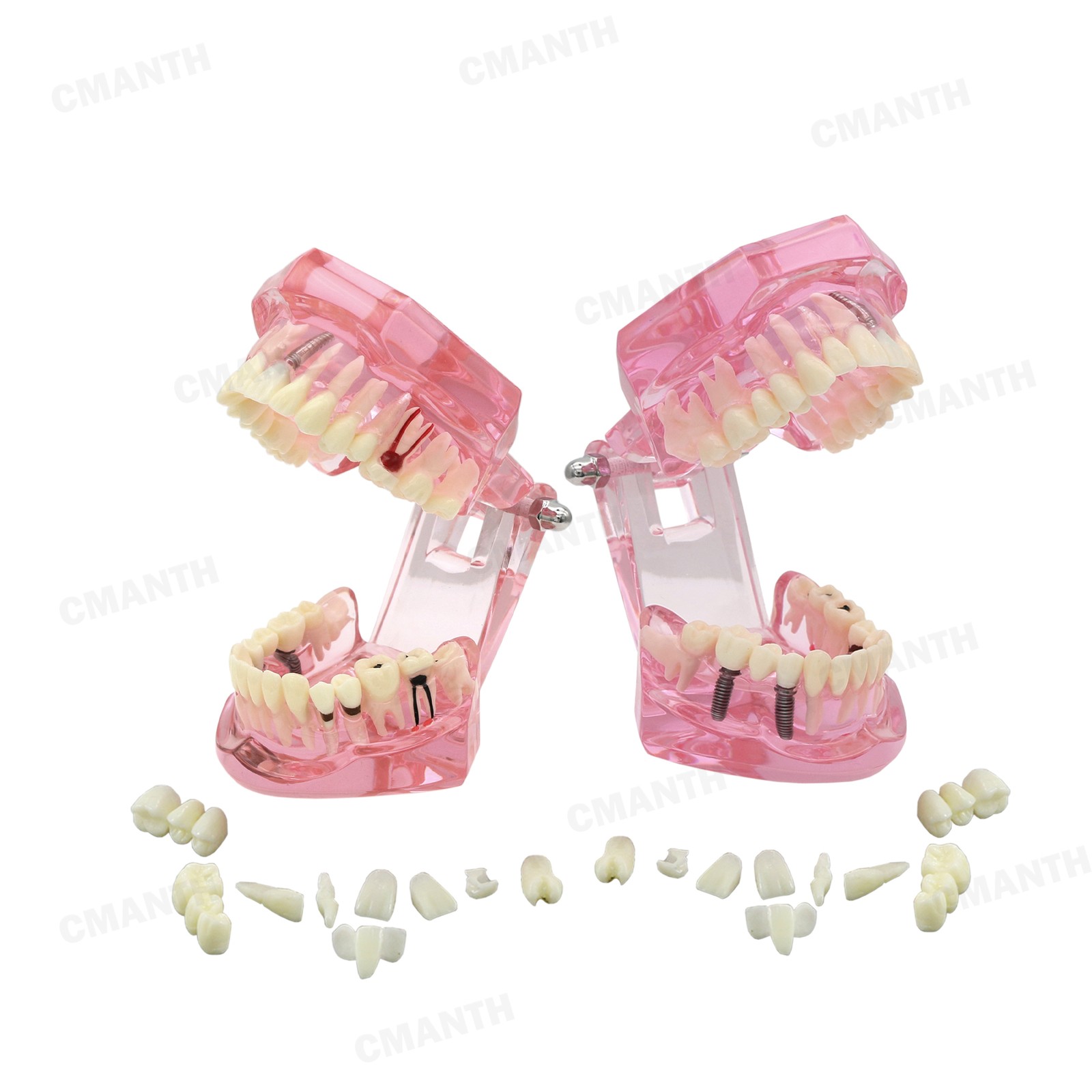 US Dental Teeth Implant Restoration Model Transparent Pathological Study Demo