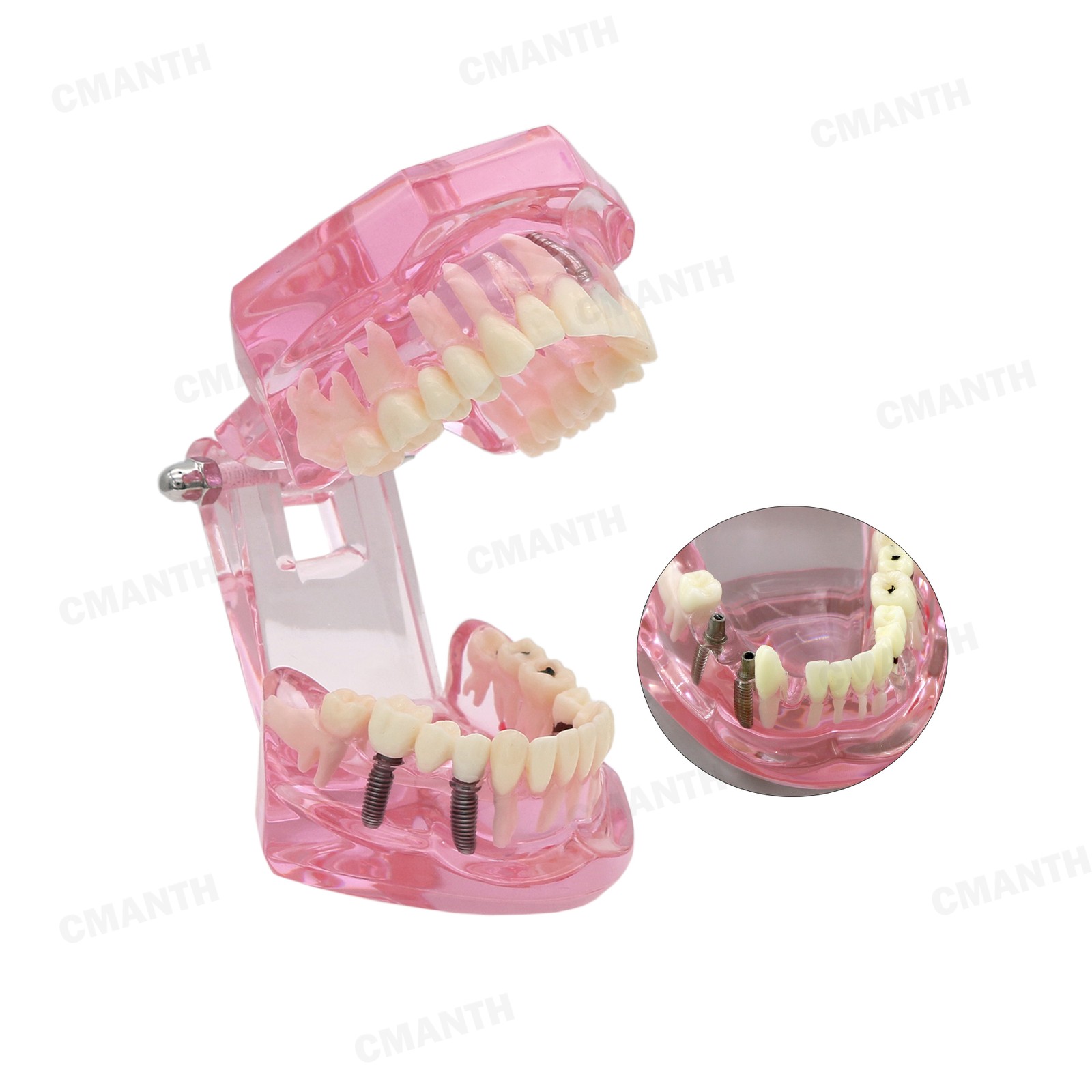 US Dental Teeth Implant Restoration Model Transparent Pathological Study Demo