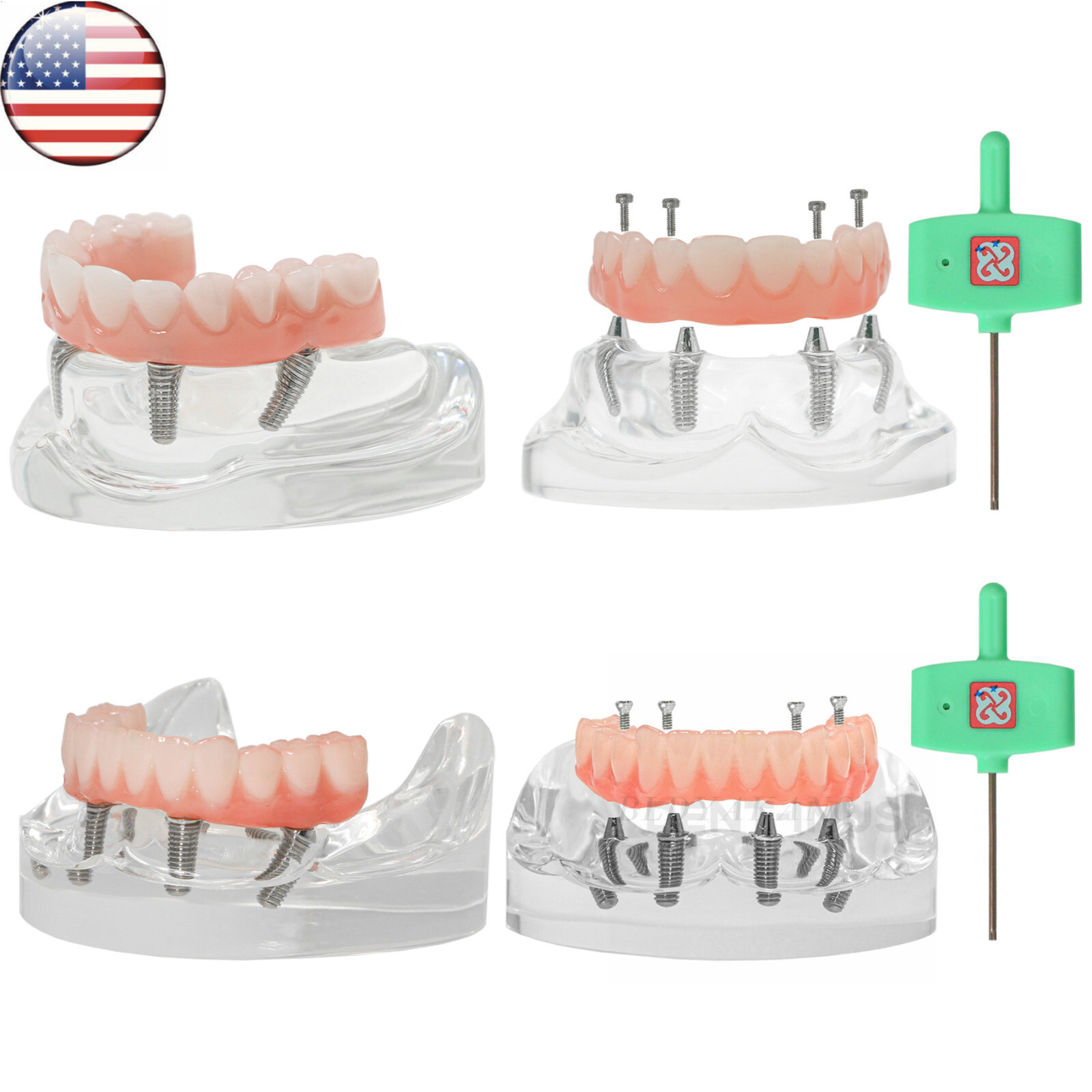 US Dental Overdenture All-on-4 Model Upper/Lower Jaw-Clear Implant With 4 Screws