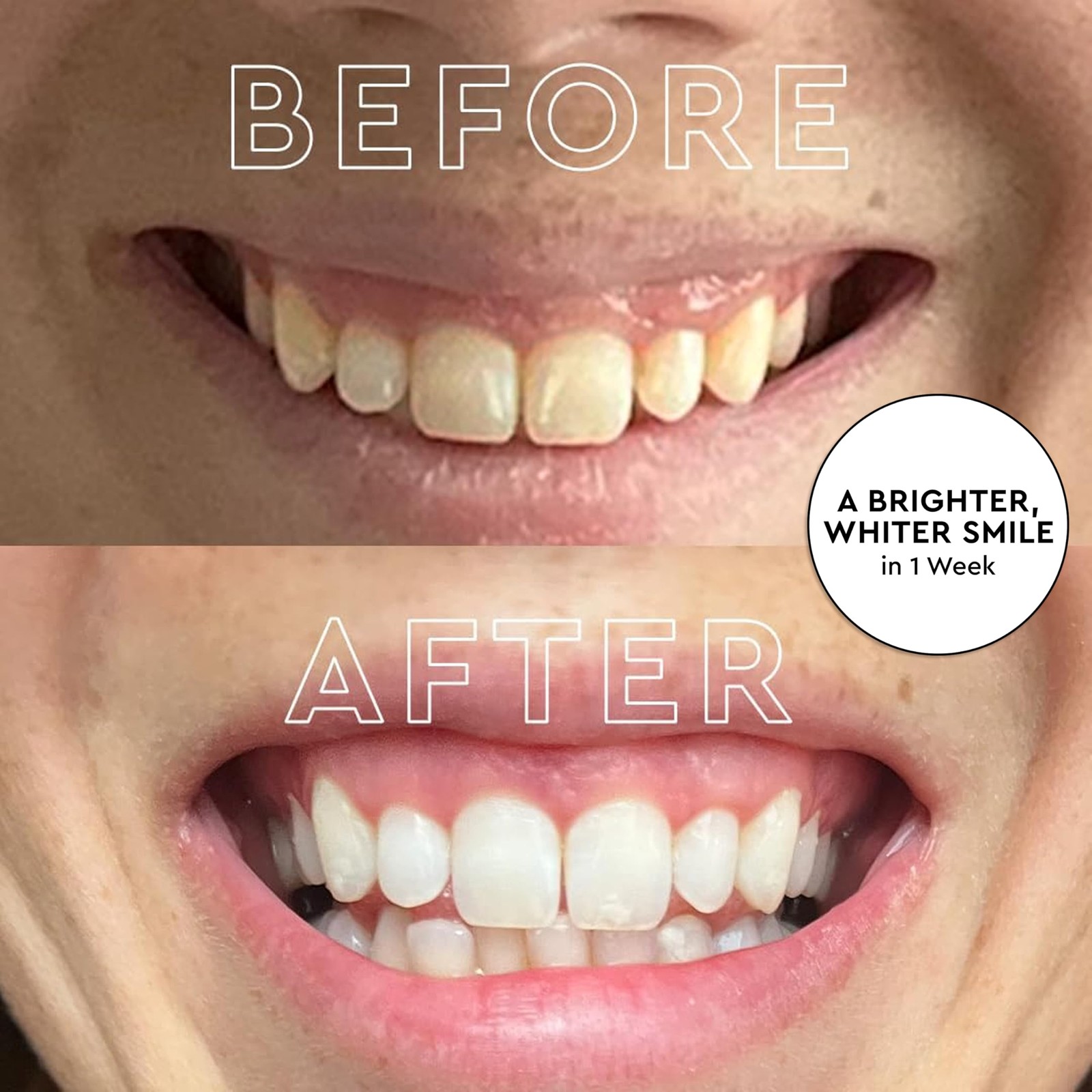 MOON Teeth Whitening Kit, Platinum Whitener 1 Count (Pack of 1), Black