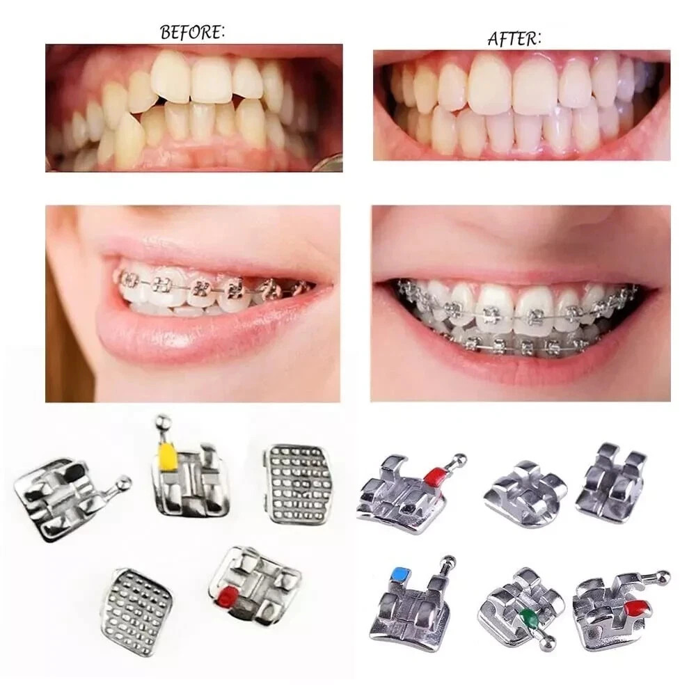 Dental Orthodontic Metal Bracket Braces Edgewise Roth/Mini/Standard 018/022 Slot
