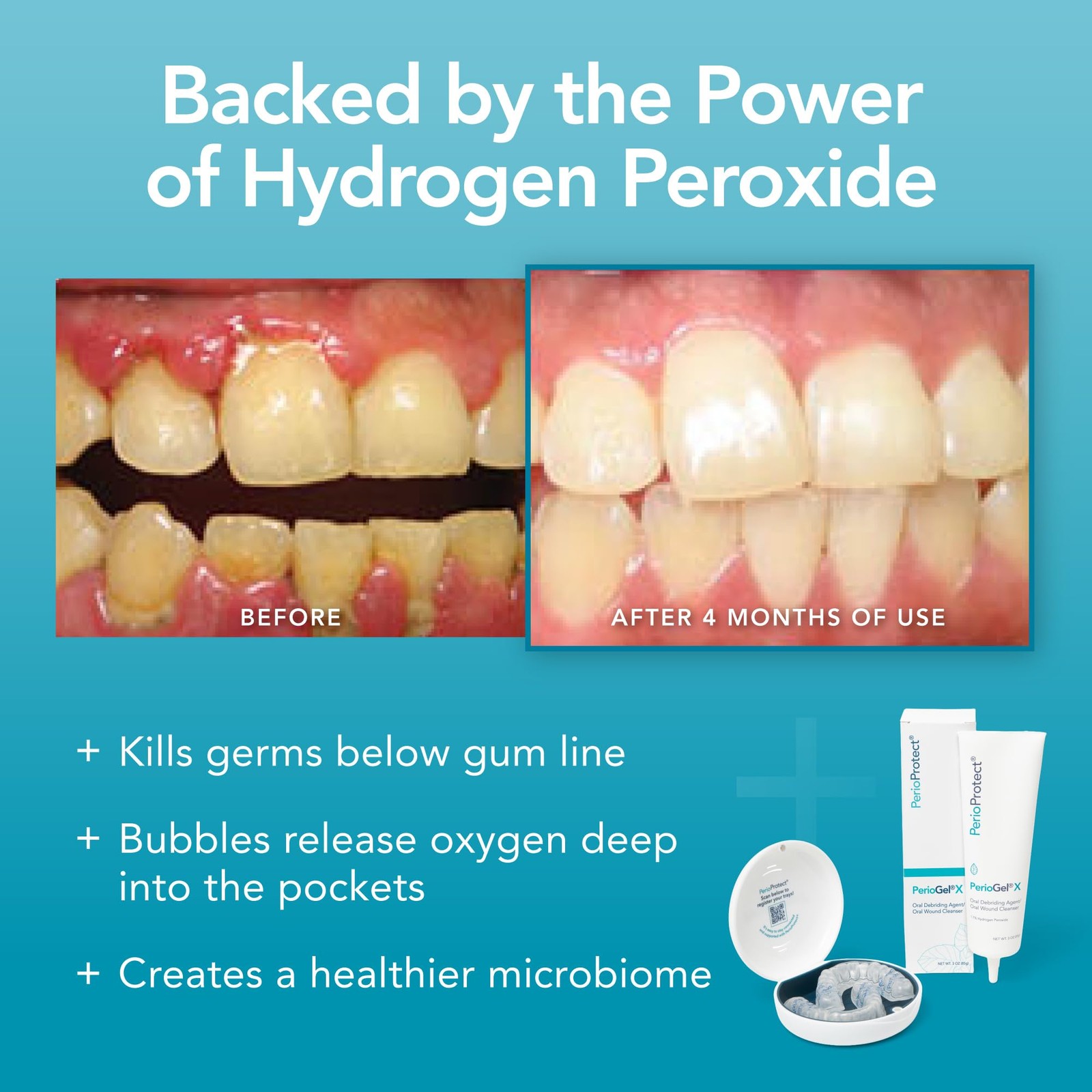 PerioGelX | Periodontal Treatment for Teeth | Promotes 3 Fl Oz (Pack of 1)