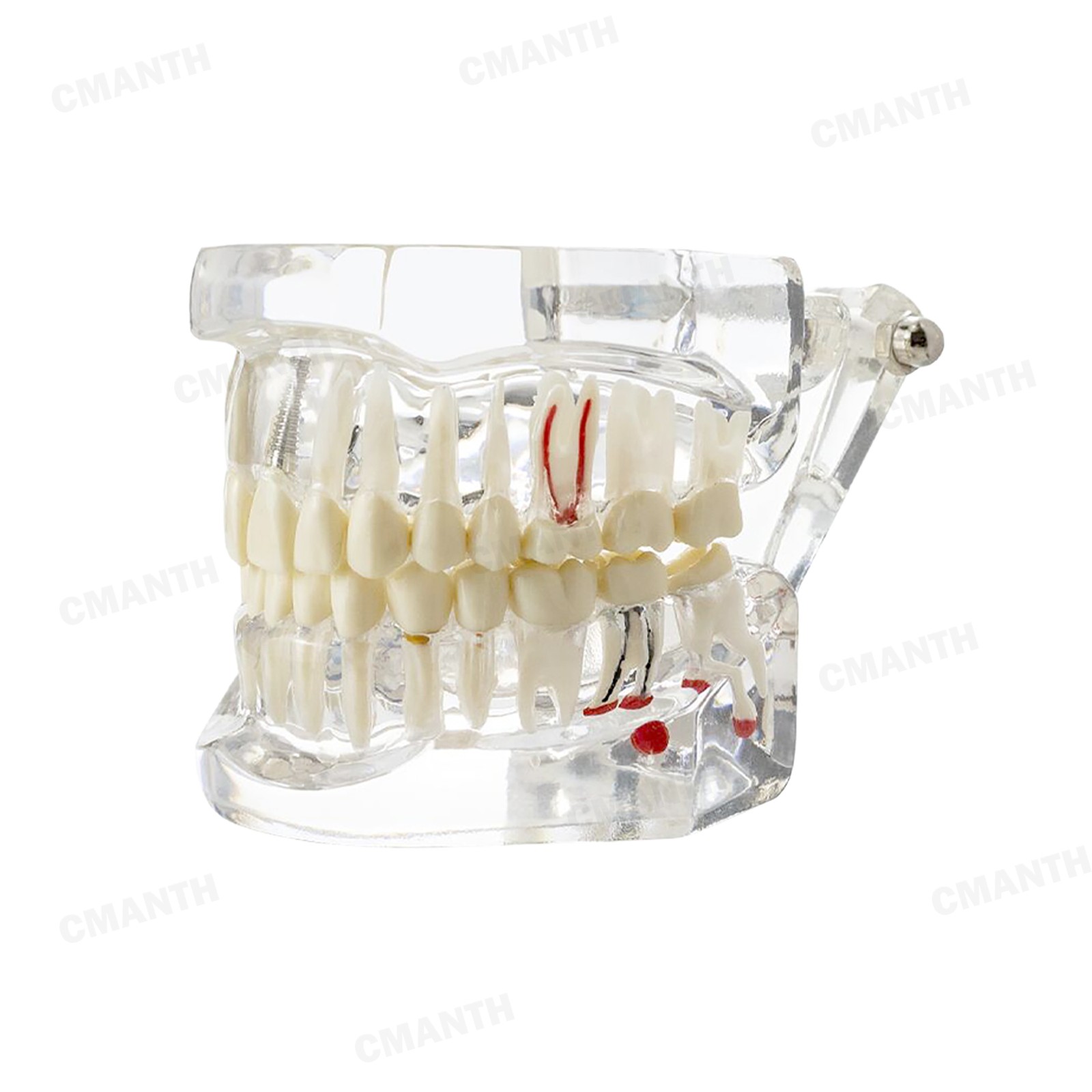 US Dental Teeth Implant Restoration Model Transparent Pathological Study Demo