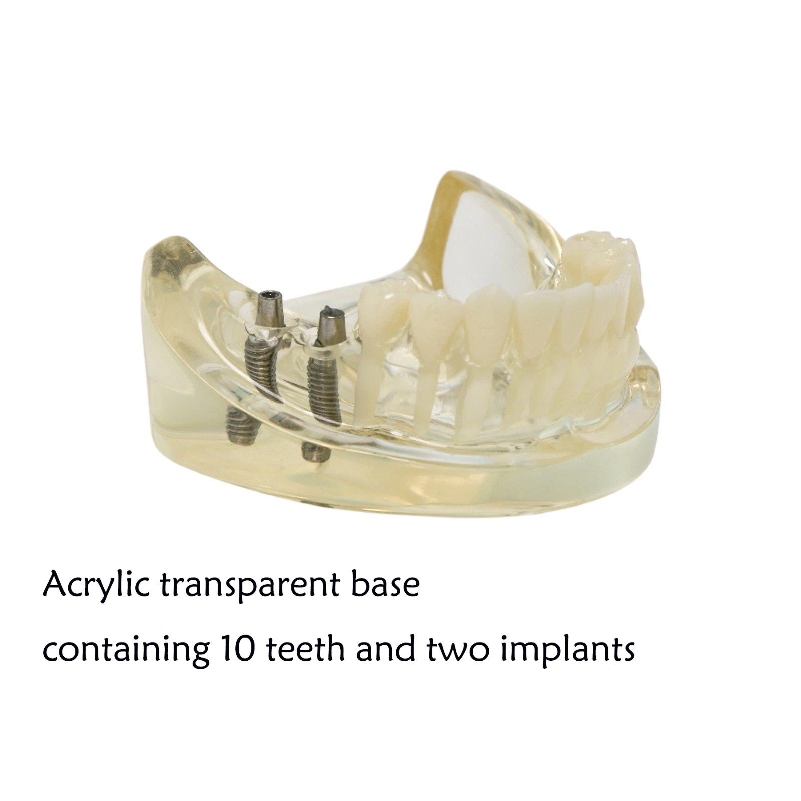Typodont Restoration Dental Teeth Model With Partial Denture Demo 2 Implants