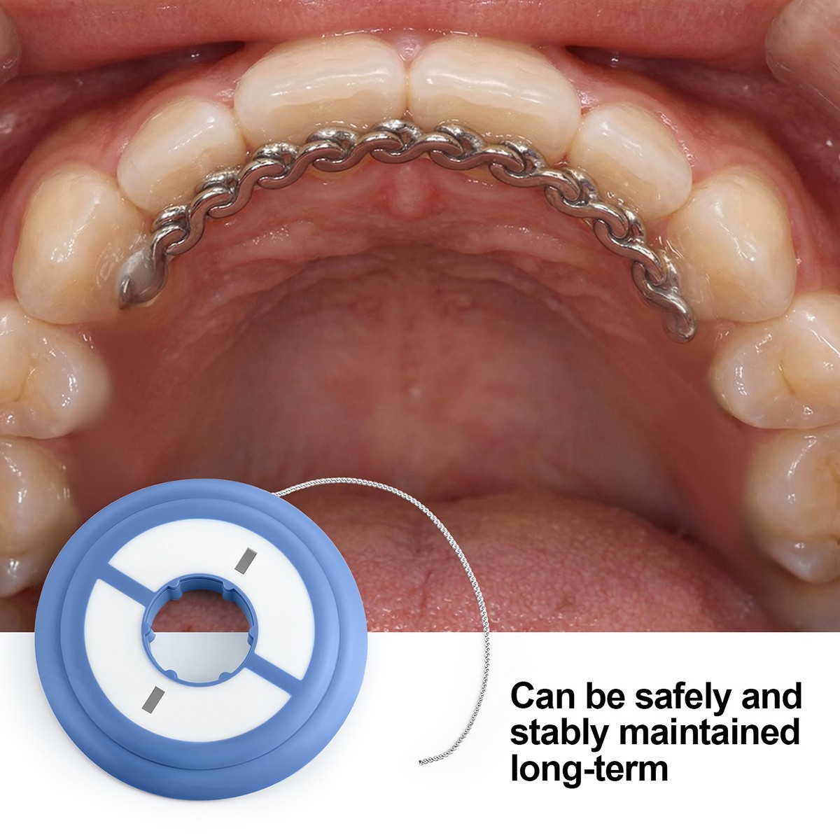 Dental Orthodontic Metal Lingual Button Round Rectangular monoblock Bondable