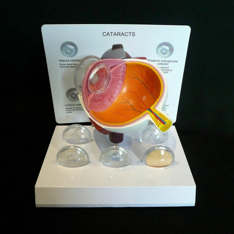 Anatomical Model of Human Cataract and Eye Disease-Medical Pathology Anatomy