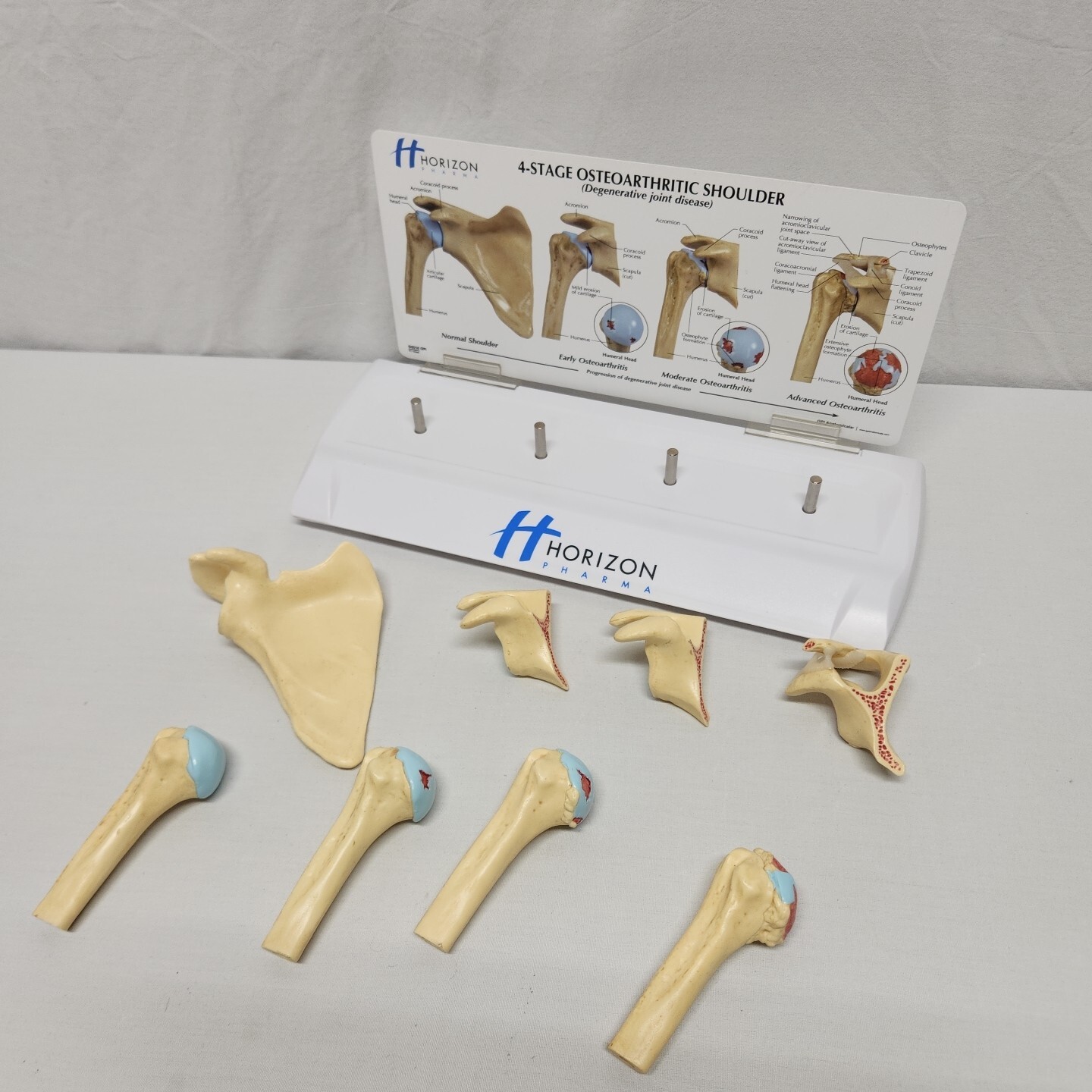 Degenerative Joint Disease 4 Stage Osteoarthritis Osteoarthritic Shoulder Model