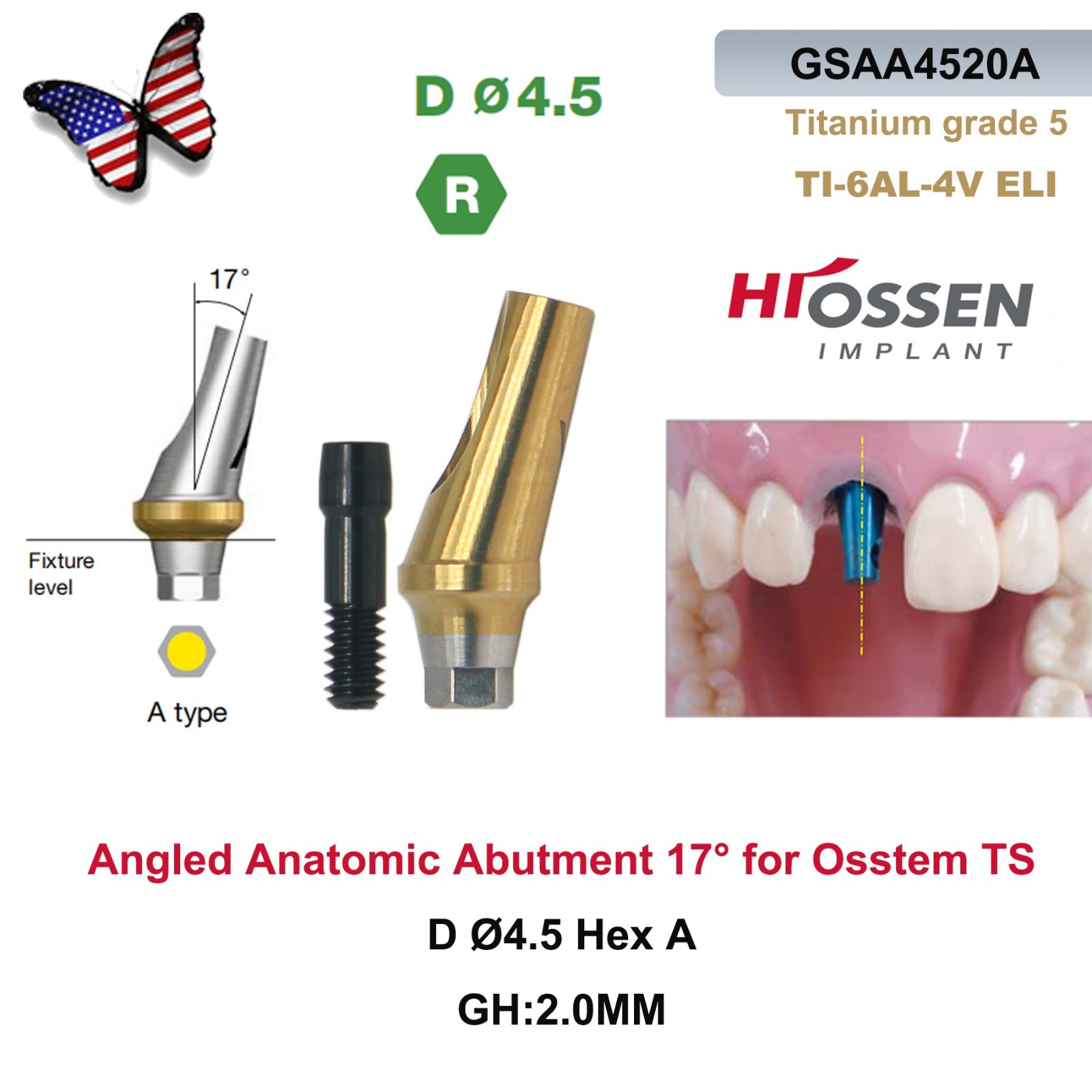 US 5Pcs 17° Angled Anatomic Abutment Hiossen Osstem Mini Regular Hex Titanium