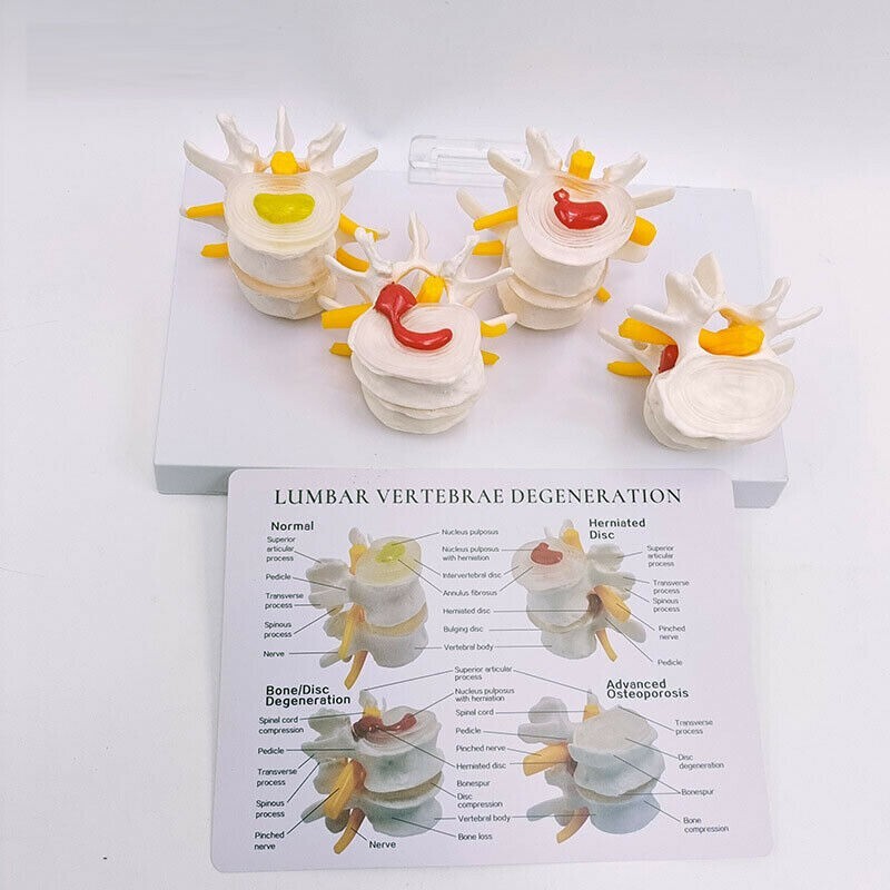 Sick Human Lumbar Vertebrae Degenerative Disc Disease Model Anatomical