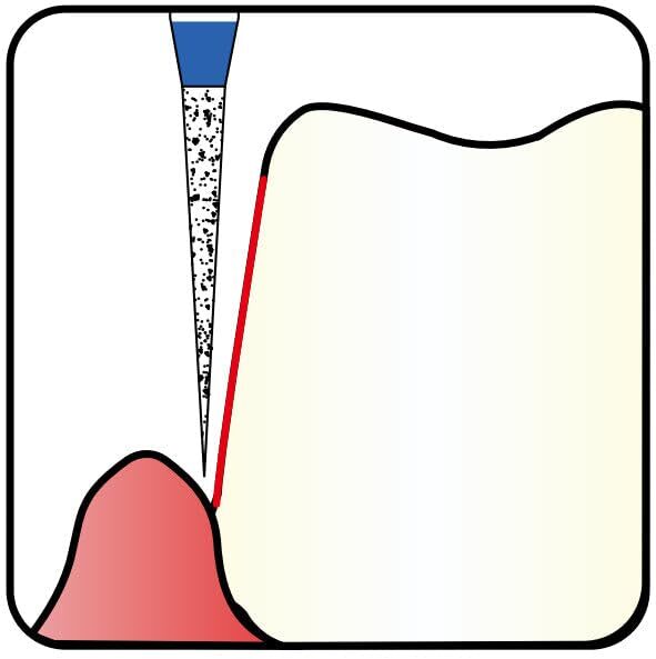 Conical Pointed, Slender 1.2 mm Dia. Medium Grit Diamond Dental Bur 25 Pcs