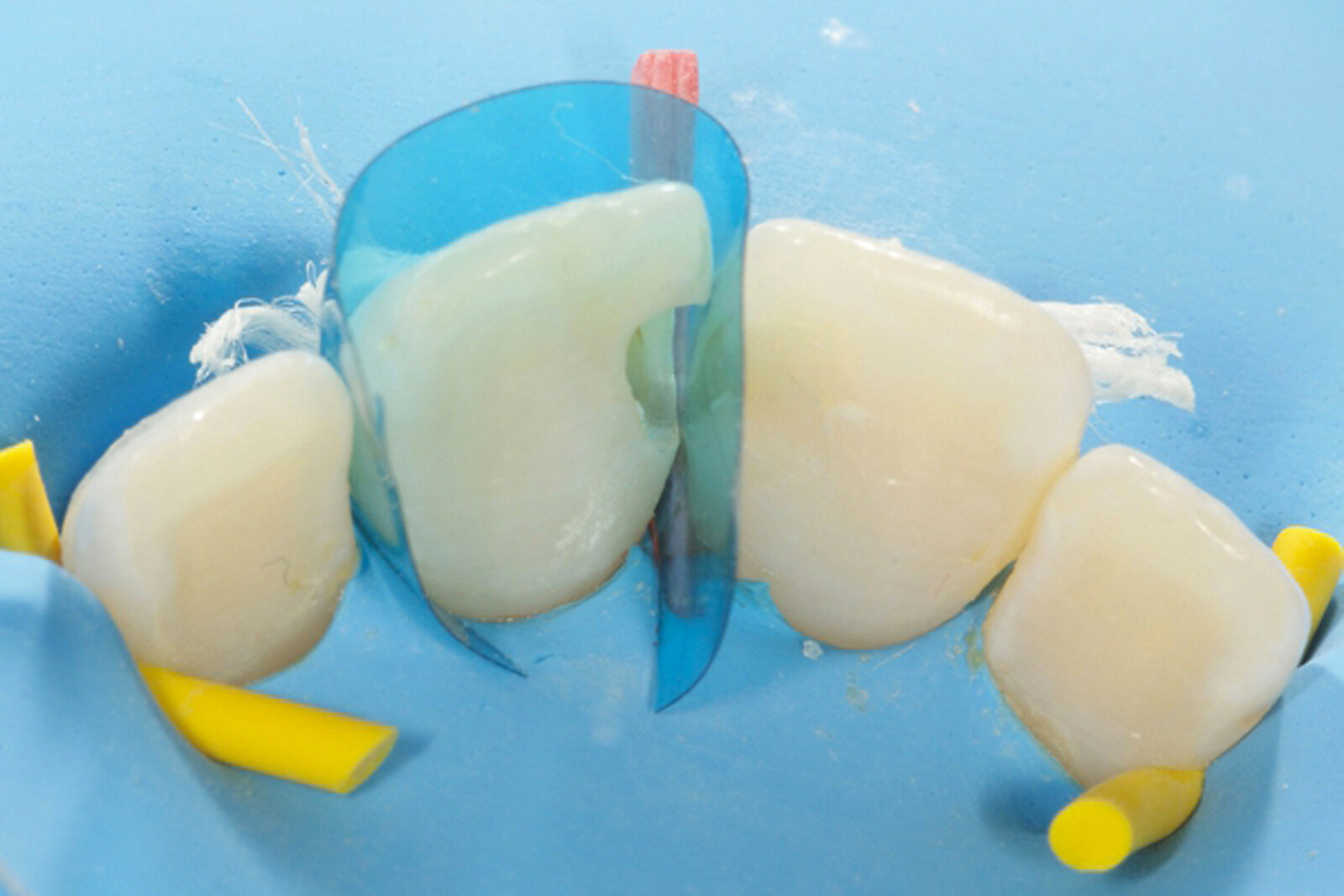Dental Blue view varistrip Contoured Anterior Matrix Bands Restoration Matrices