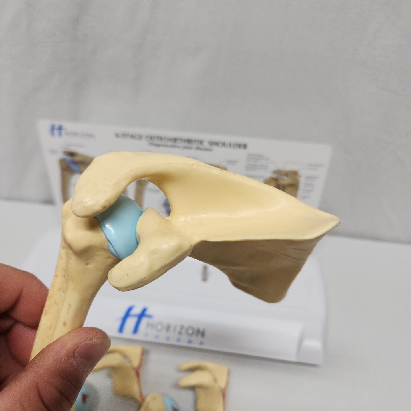 Degenerative Joint Disease 4 Stage Osteoarthritis Osteoarthritic Shoulder Model