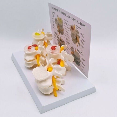 Sick Human Lumbar Vertebrae Degenerative Disc Disease Model Anatomical