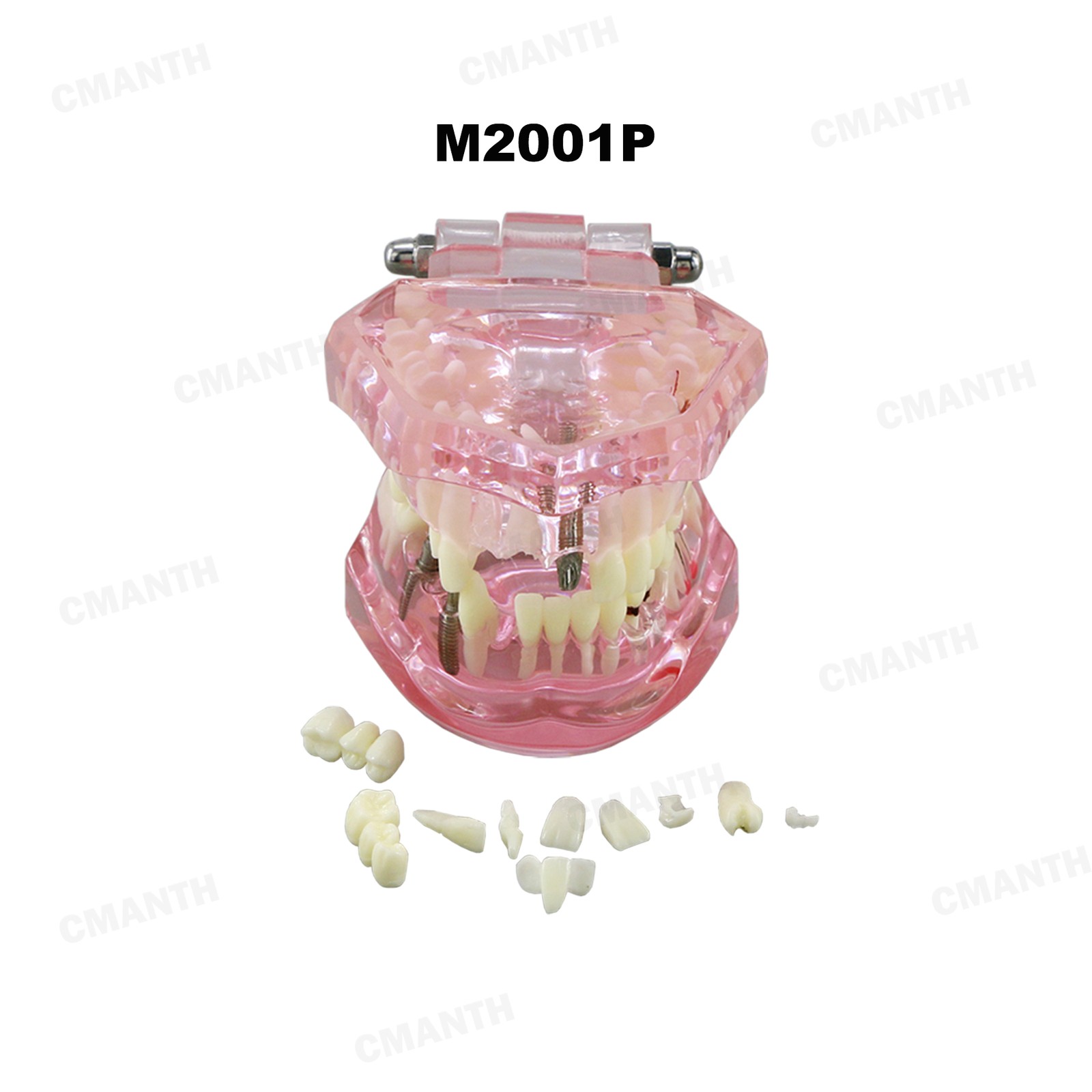 US Dental Teeth Implant Restoration Model Transparent Pathological Study Demo