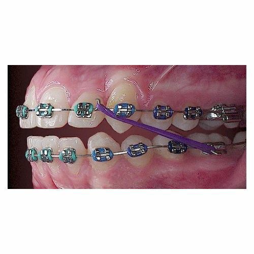 5x Dental Orthodontic Intraoral Latex Elastics Rubber Teeth Chipmunk Ø1/8″