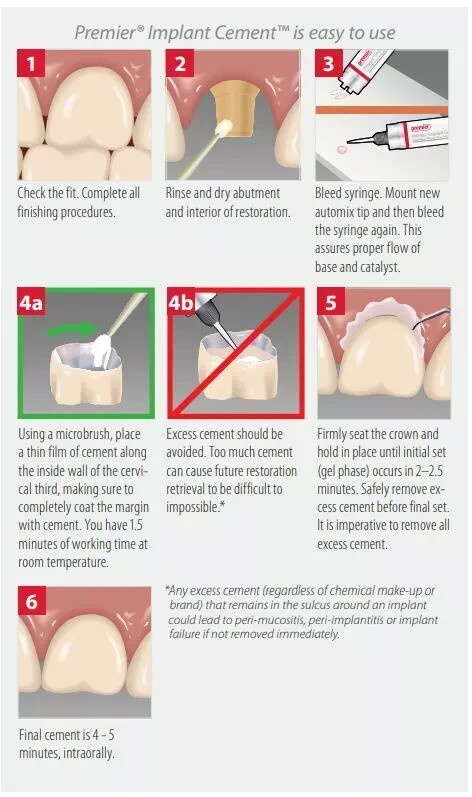 Premier Dental Implant Cement For Implant Retained crowns -5 mL Syringe + 8 Tips