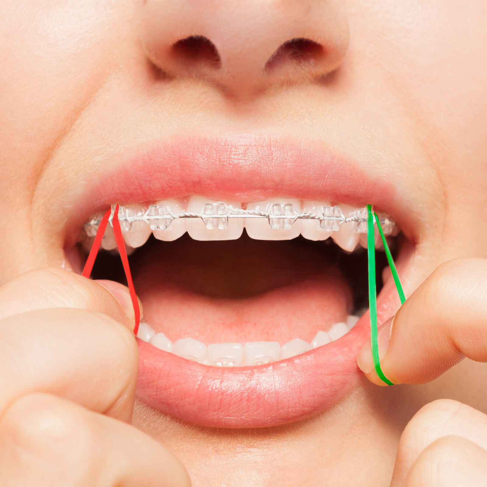 100/PK Dental Orthodontic Intraoral Elastic Rubber Bands Neon Light/Medium/Heavy