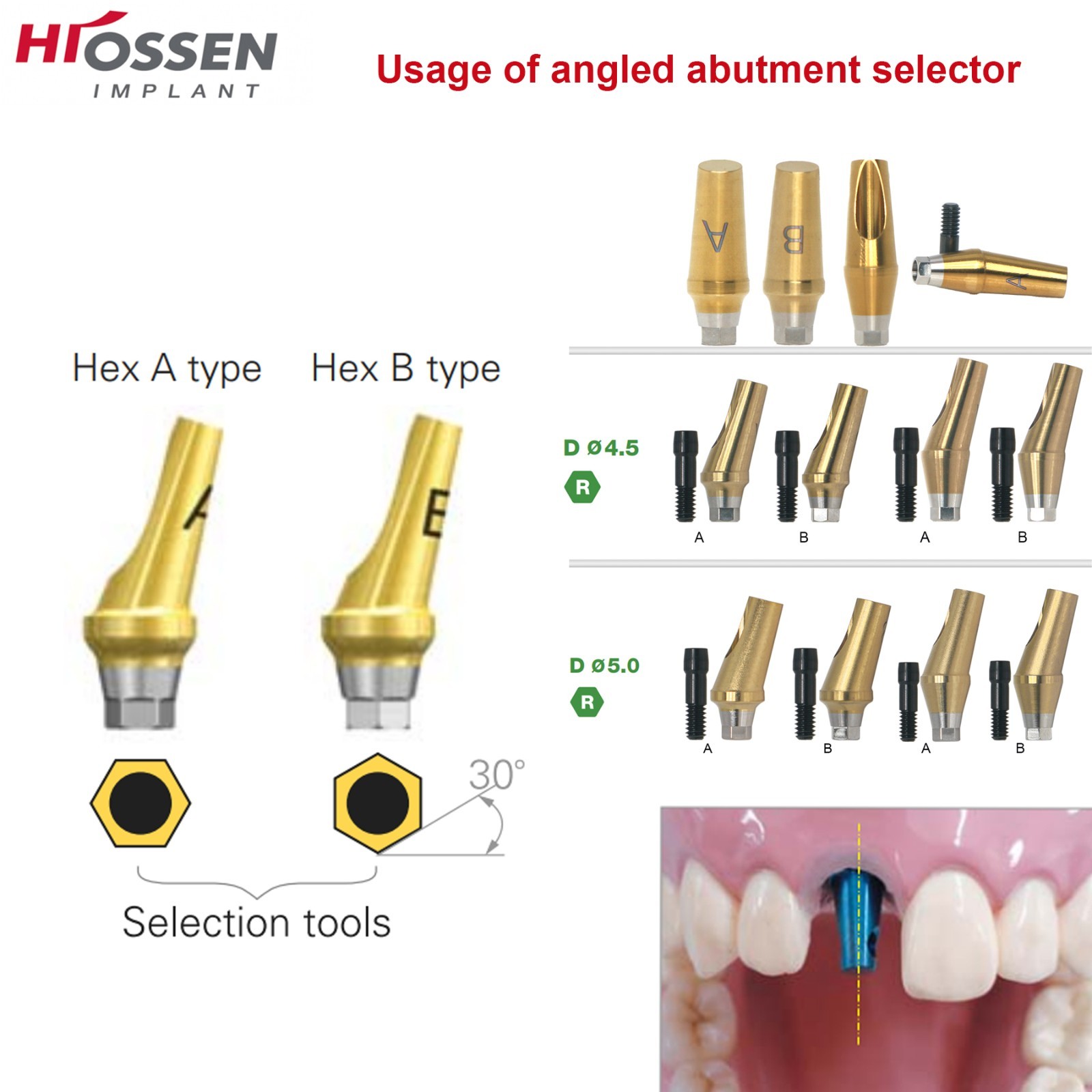 US 5Pcs 17° Angled Anatomic Abutment Hiossen Osstem Mini Regular Hex Titanium