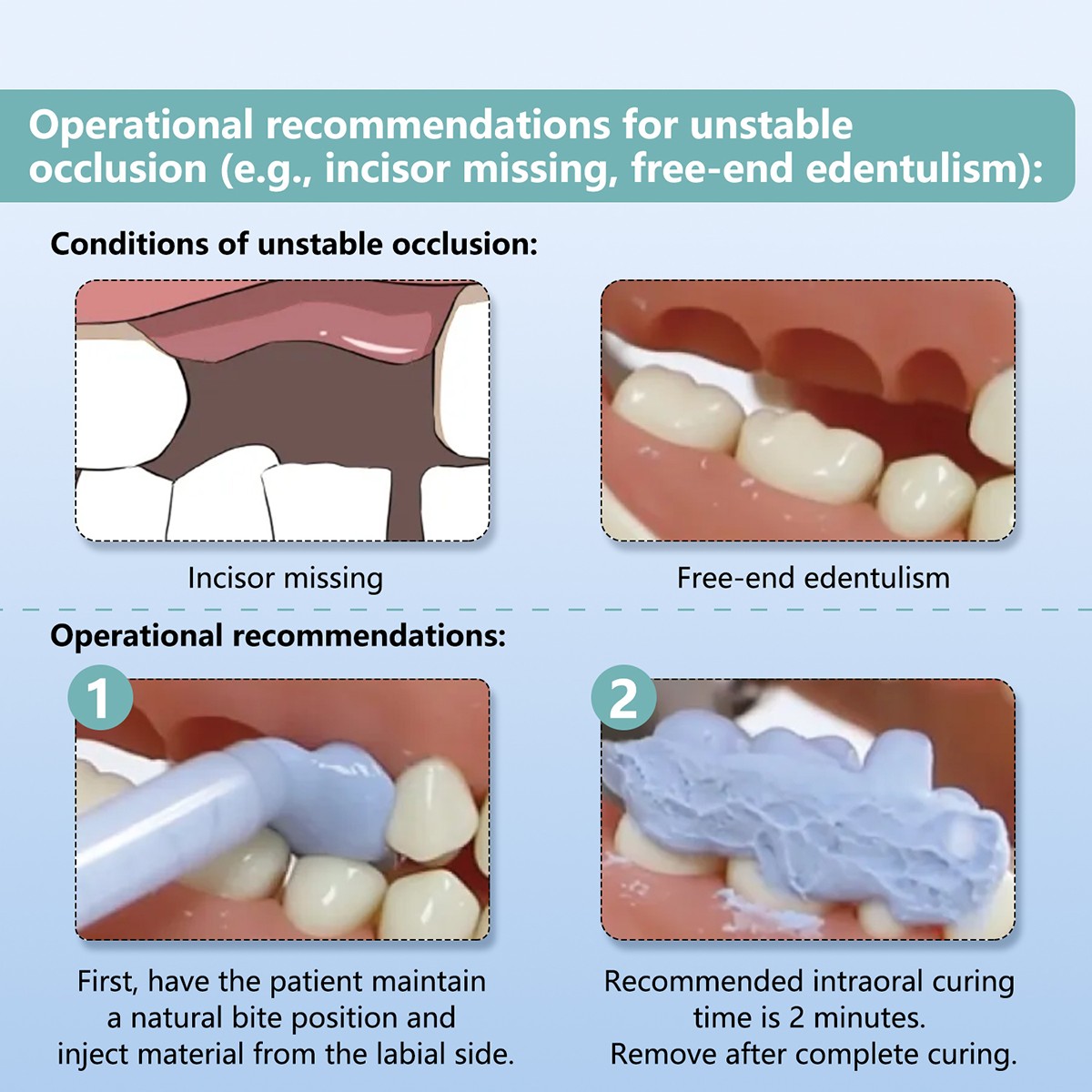 Silicone dental A para el material de registro mordedura Mezcla/Conjunto rápido