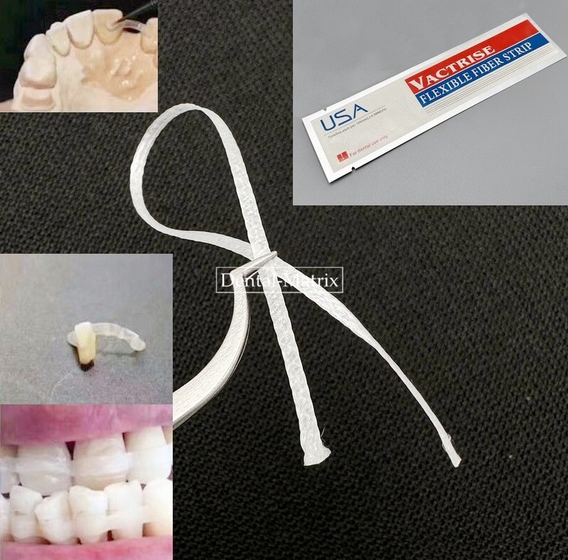 Dental Composite Flexible Fiber Strip Ribbond Ribbon Glass Fiber Splint 125*3.5