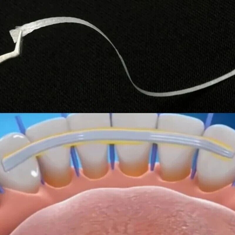 Dental Flexible Fiber Strip Glass Splint Loose Tooth Fixation Strips Light Cure