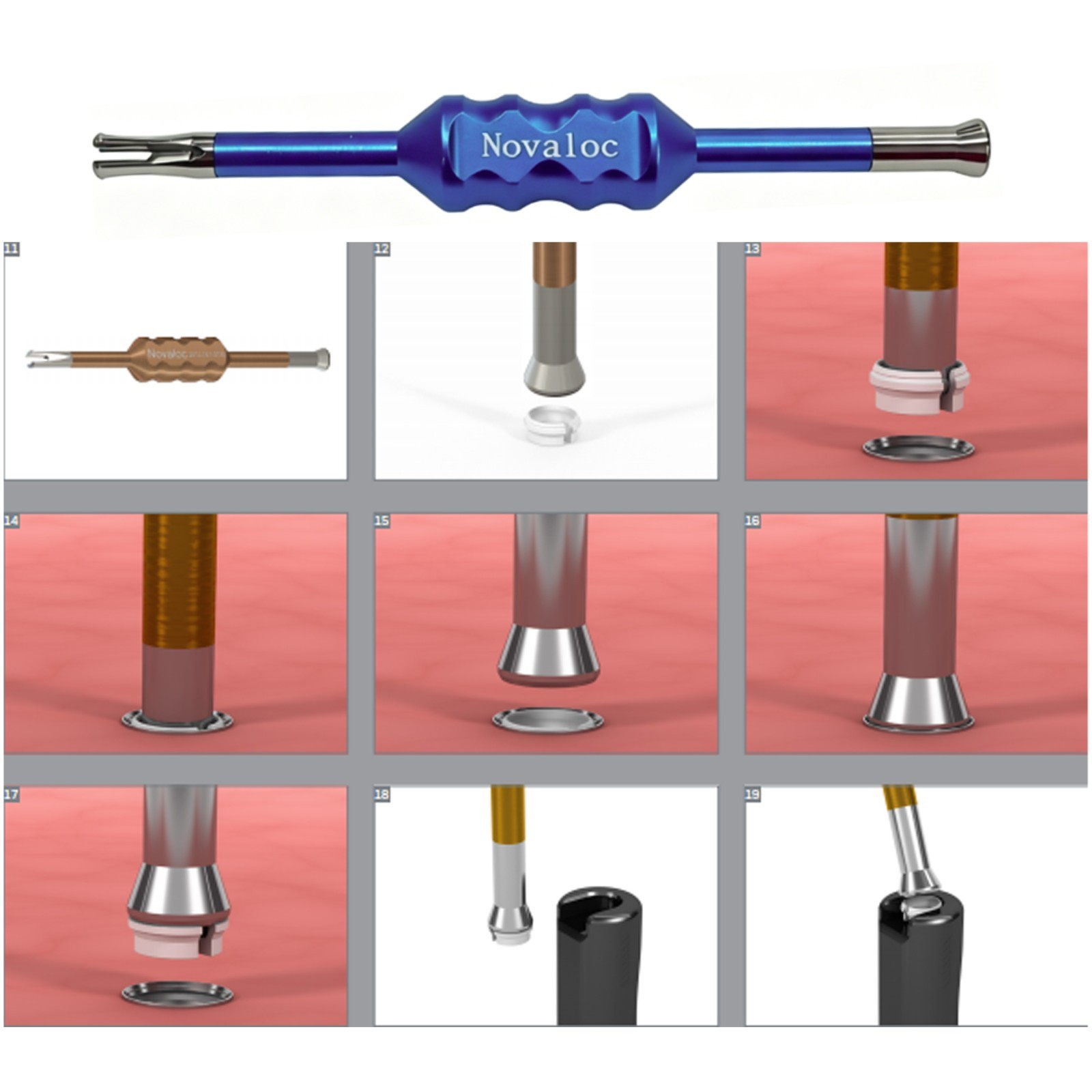 US Dental Novaloc Retention Inserts Peek Caps&Mounting and Demounting Tool