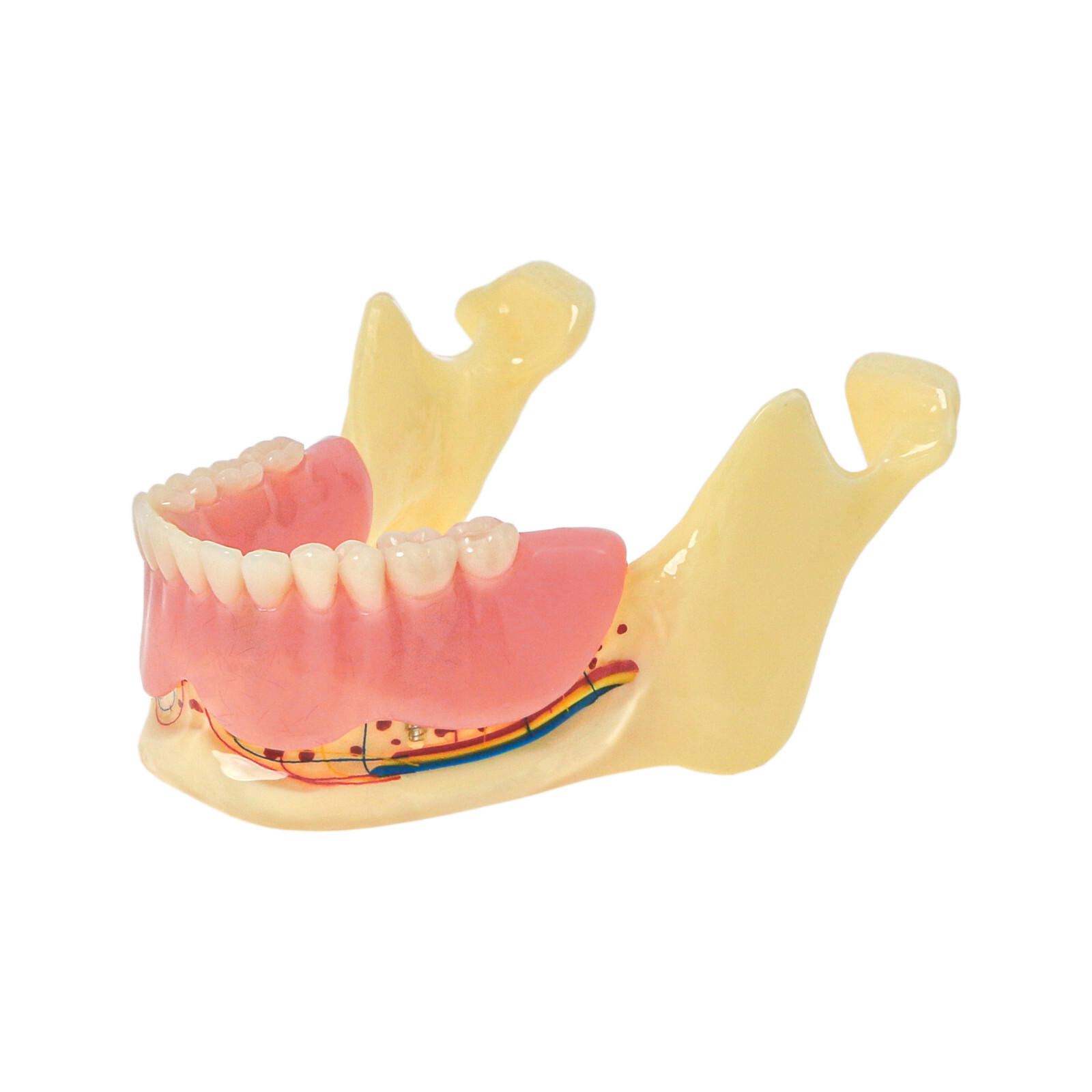 Implant Typodont Teeth Restoration Model Overdenture Practice Demo Series Dental