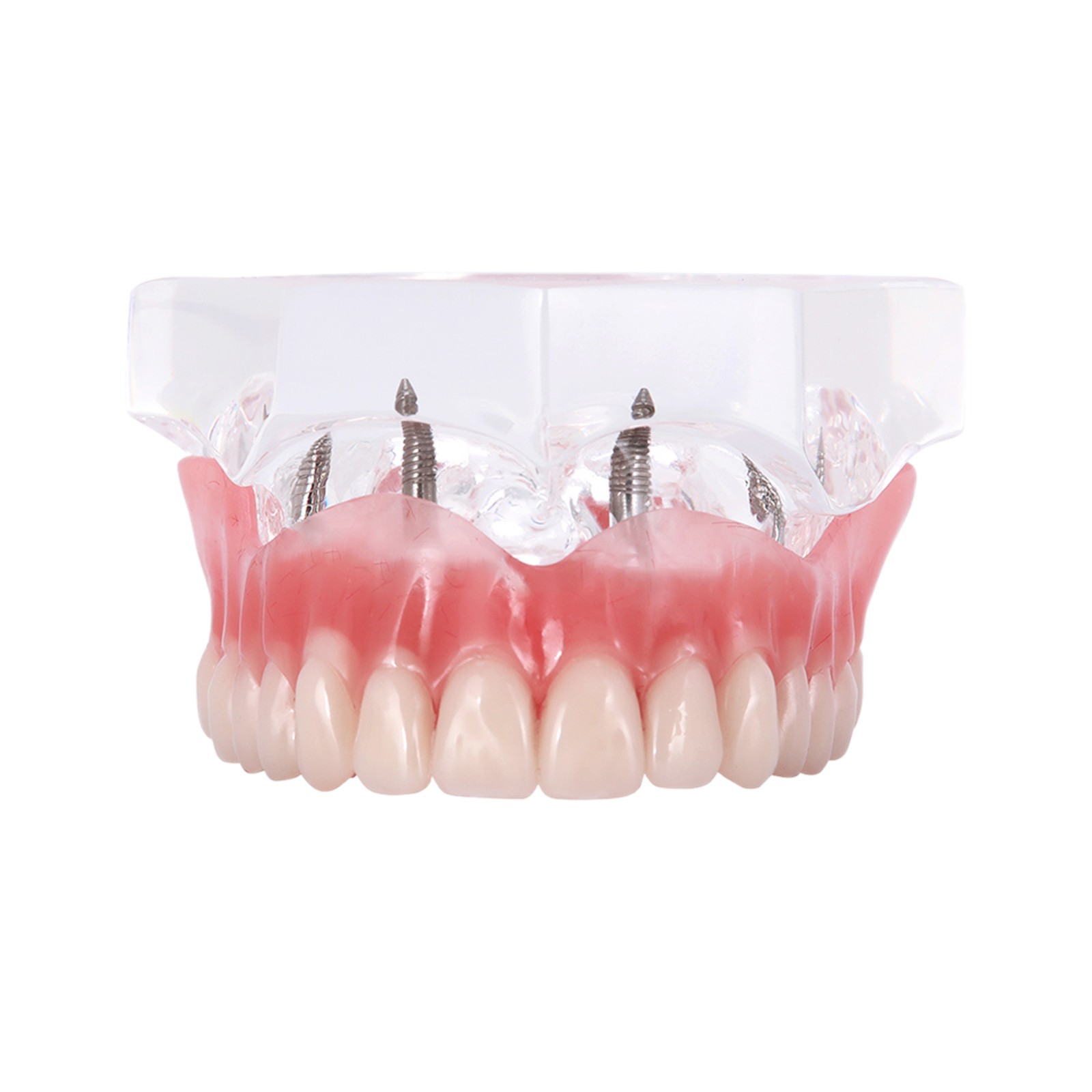 Dental Teeth Model 2 4 Implant Overdenture Typodont Restoration Demo Upper Lower